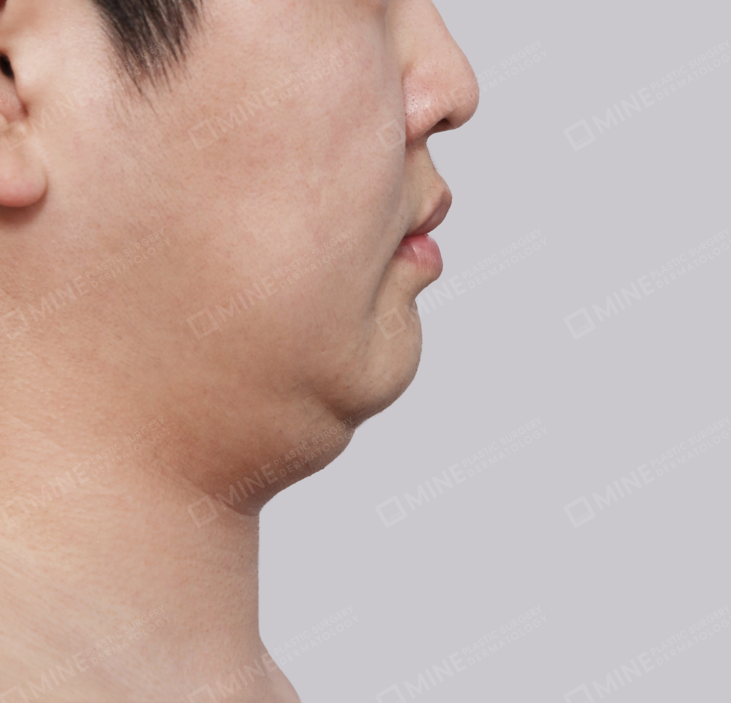 Double Chin (Vlimming)-측면-전
