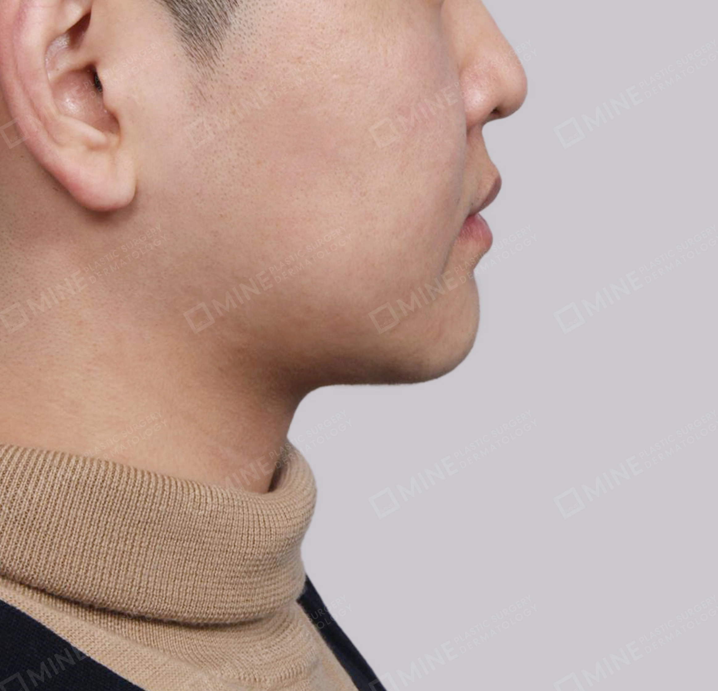 Double Chin (Vlimming)-측면-후