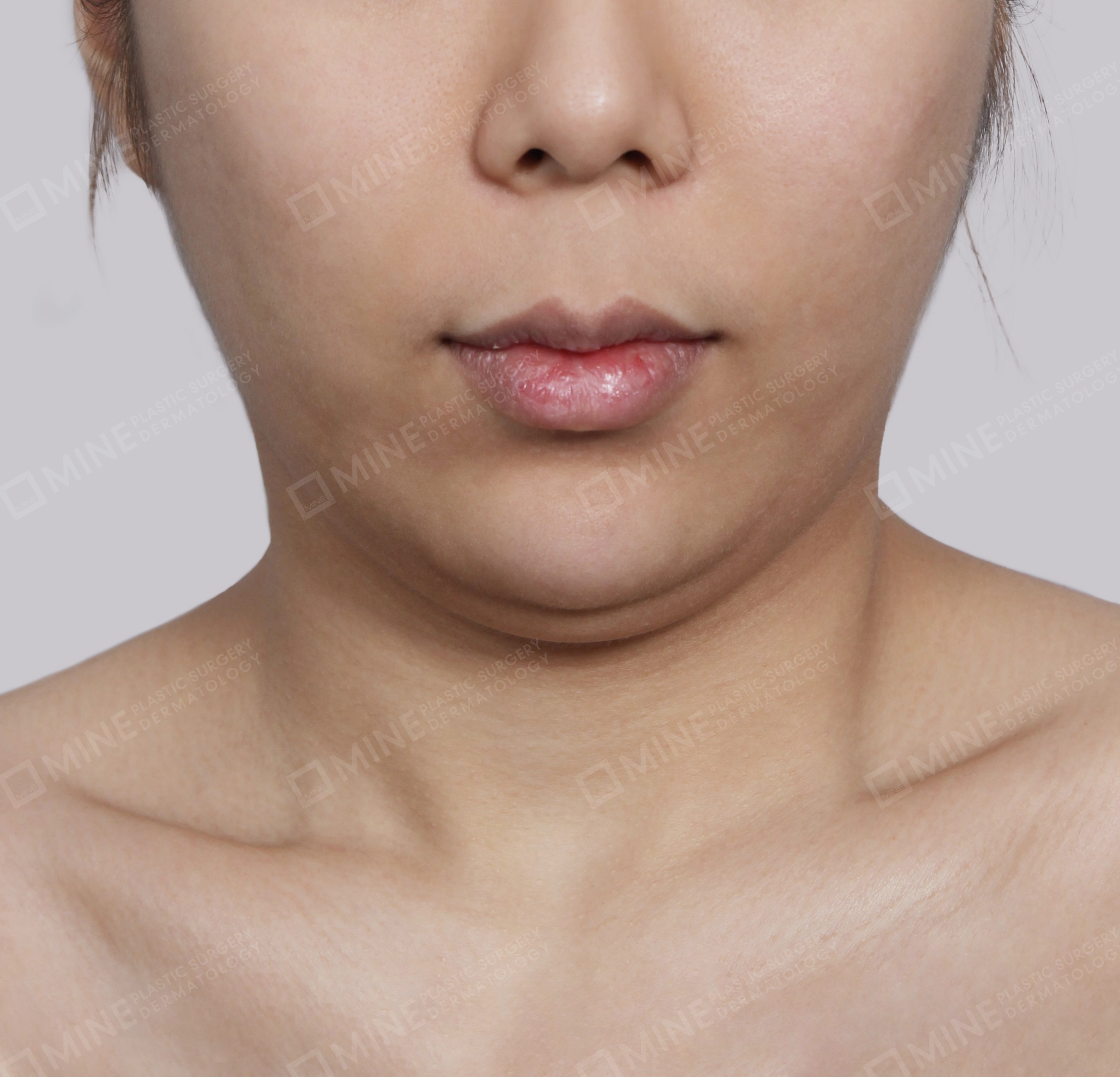 Double Chin (Vlimming)-정면-전