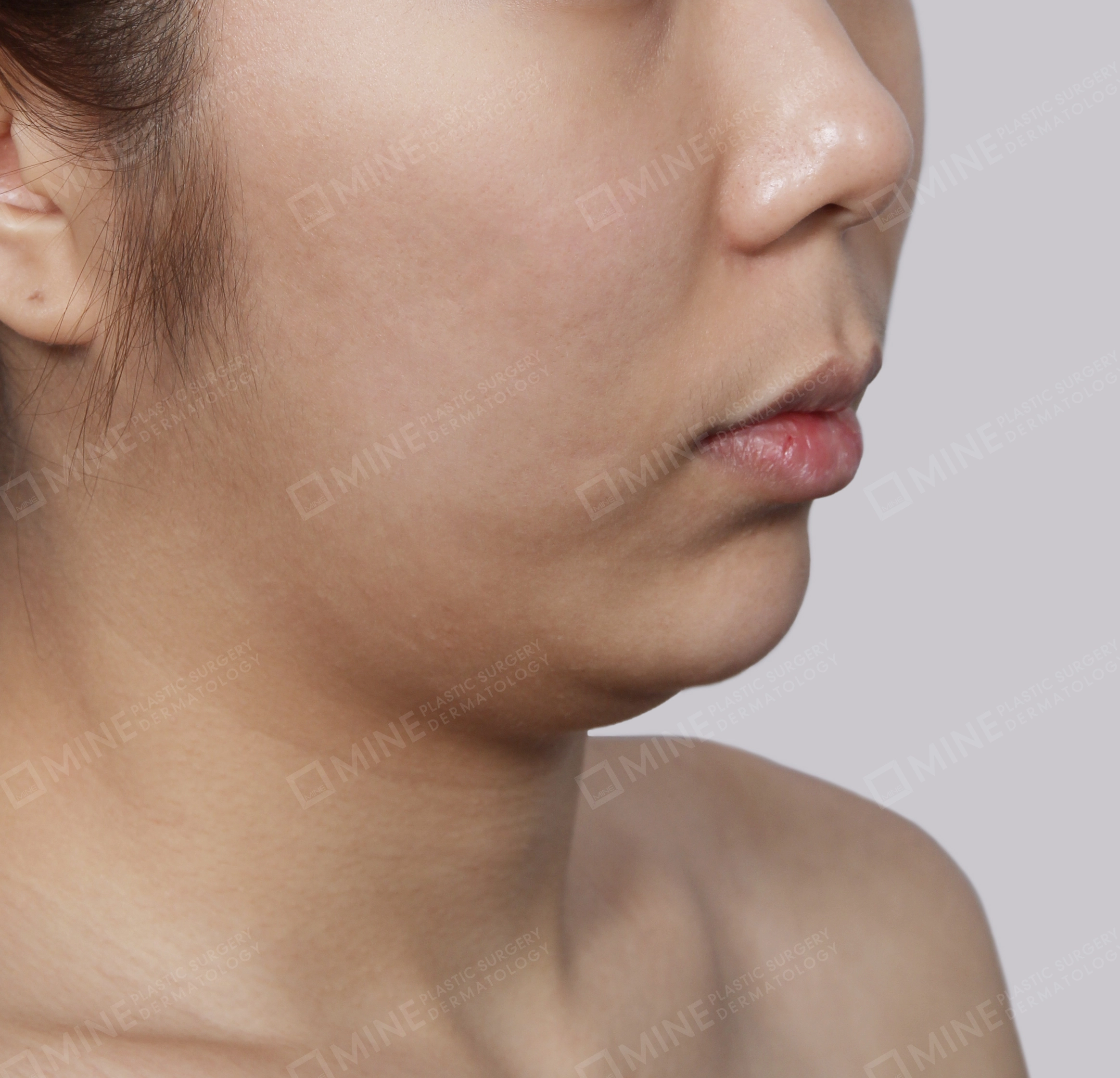 Double Chin (Vlimming)-45도-전