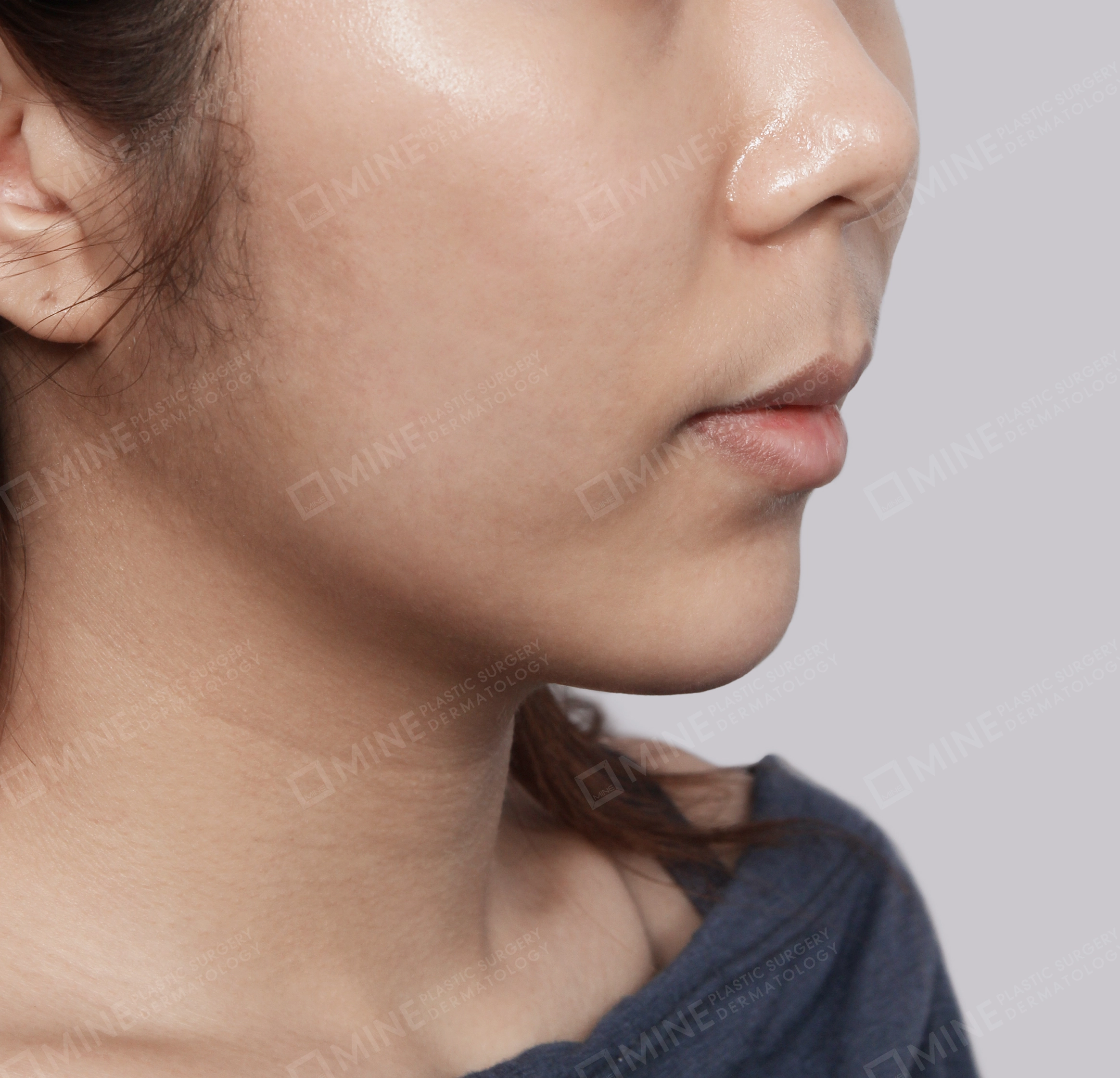 Double Chin (Vlimming)-45도-후