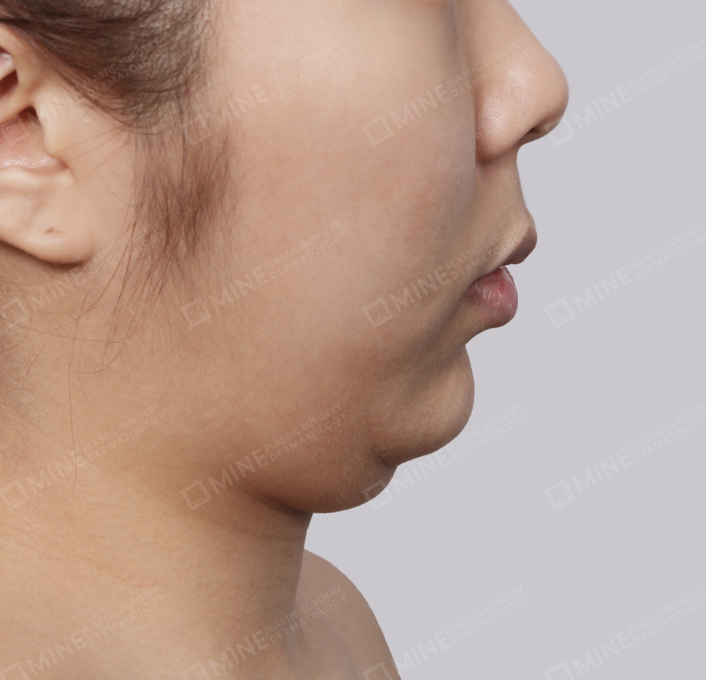 Double Chin (Vlimming)-측면-전