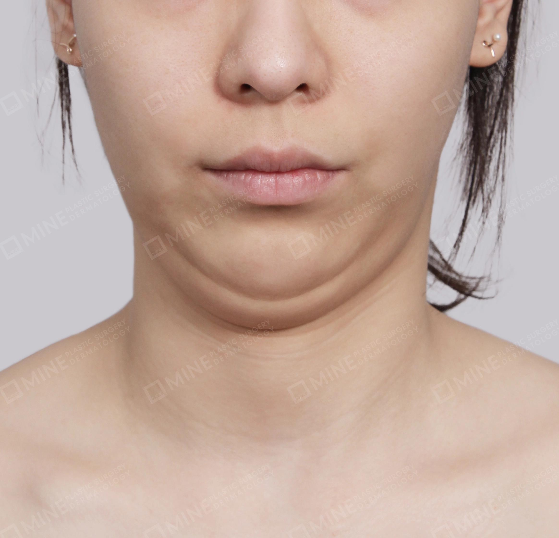 Double Chin (Vlimming)-정면-전