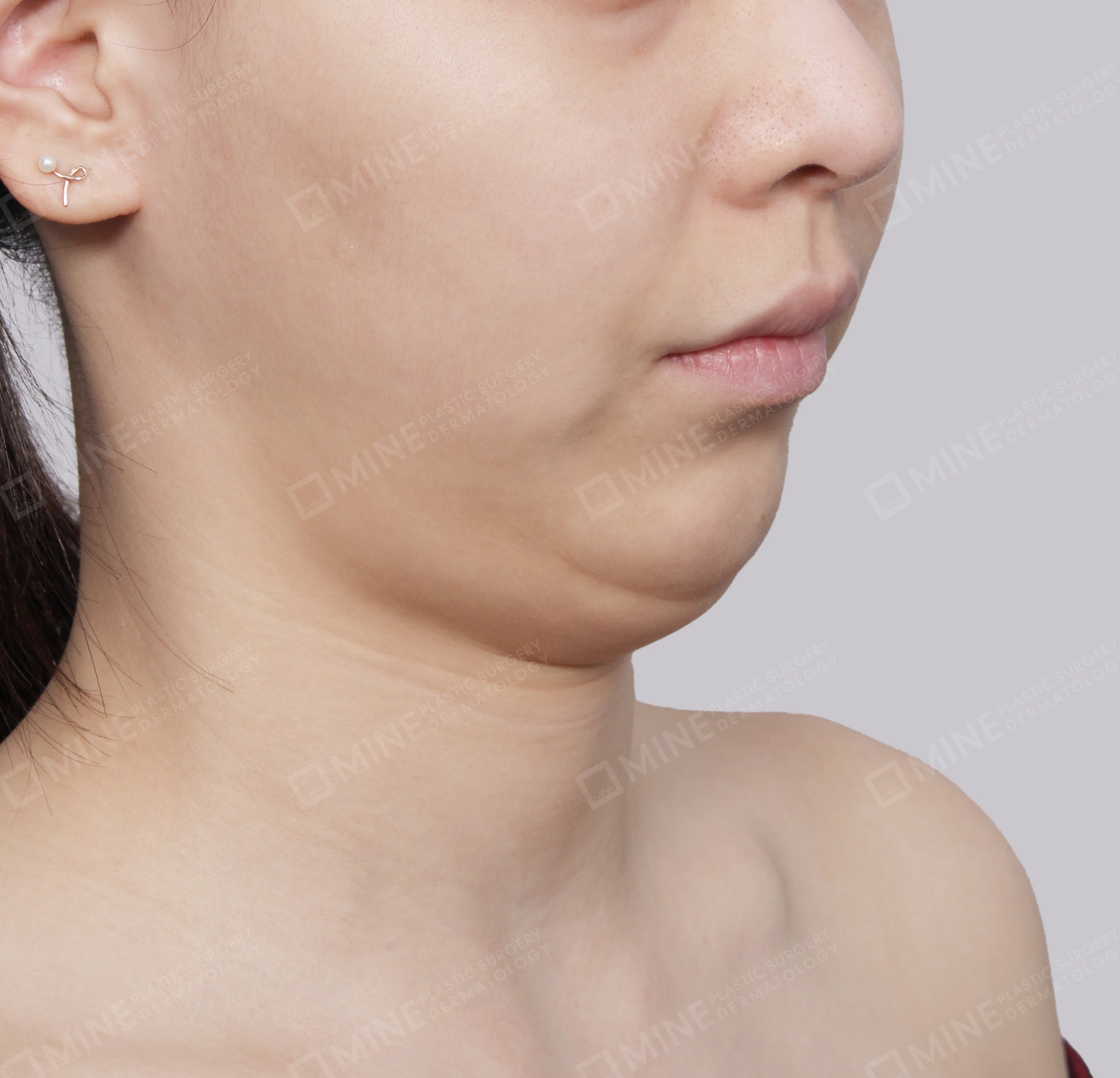 Double Chin (Vlimming)-45도-전