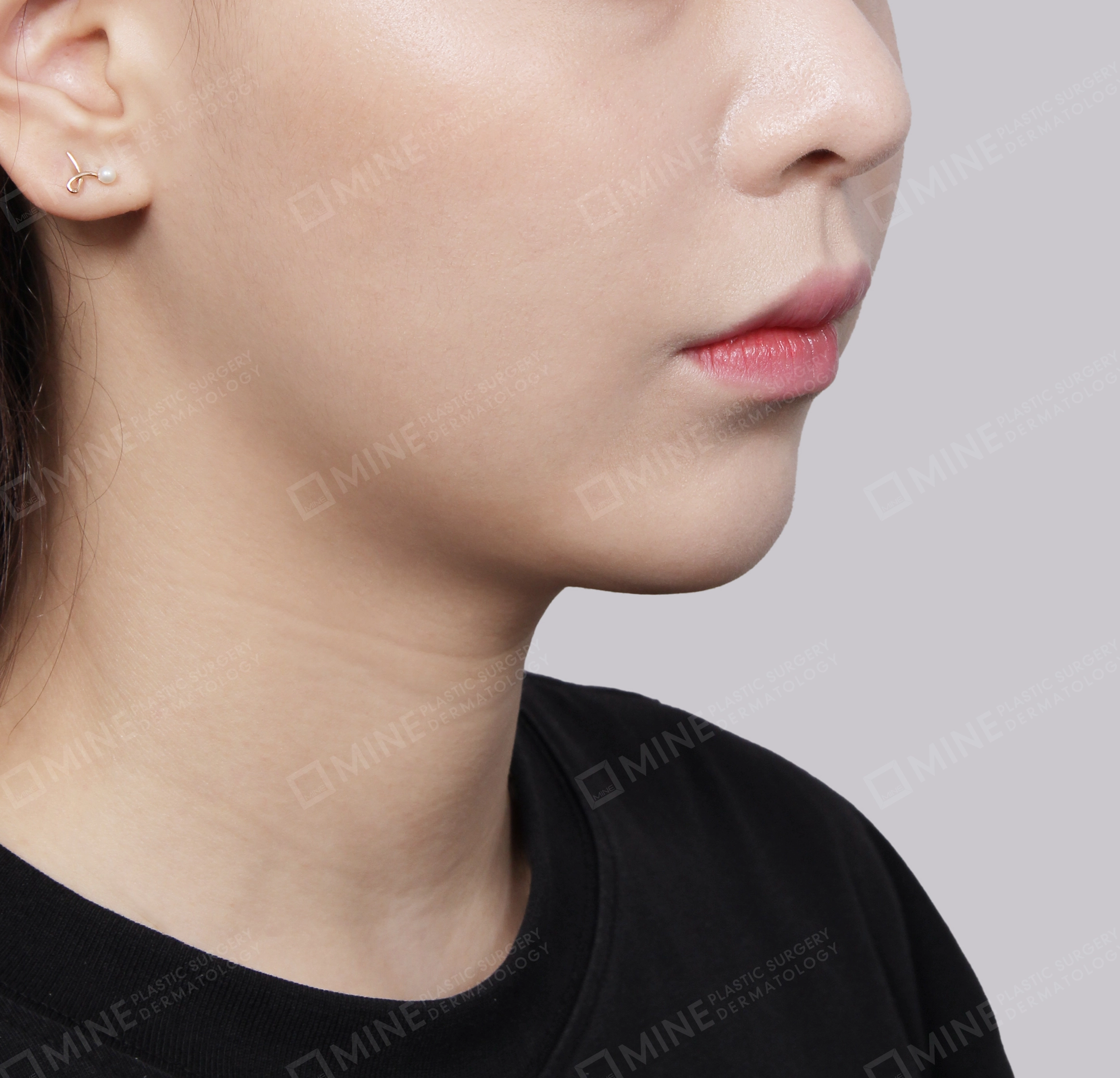 Double Chin (Vlimming)-45도-후