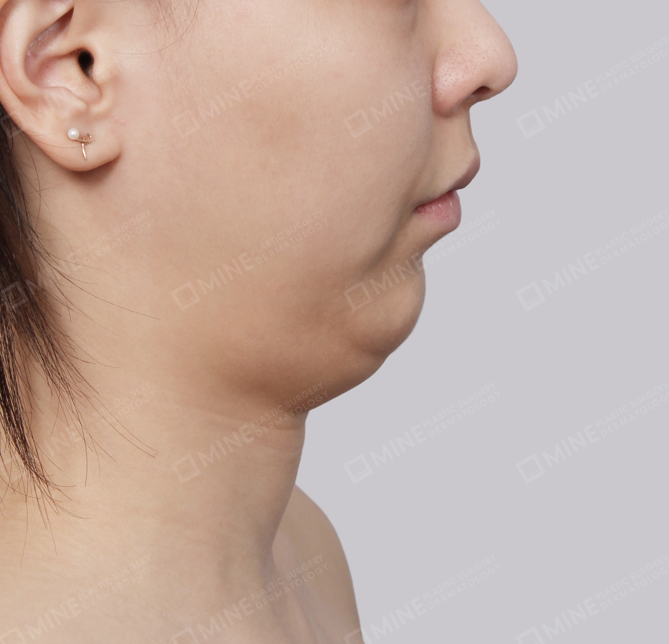 Double Chin (Vlimming)-측면-전