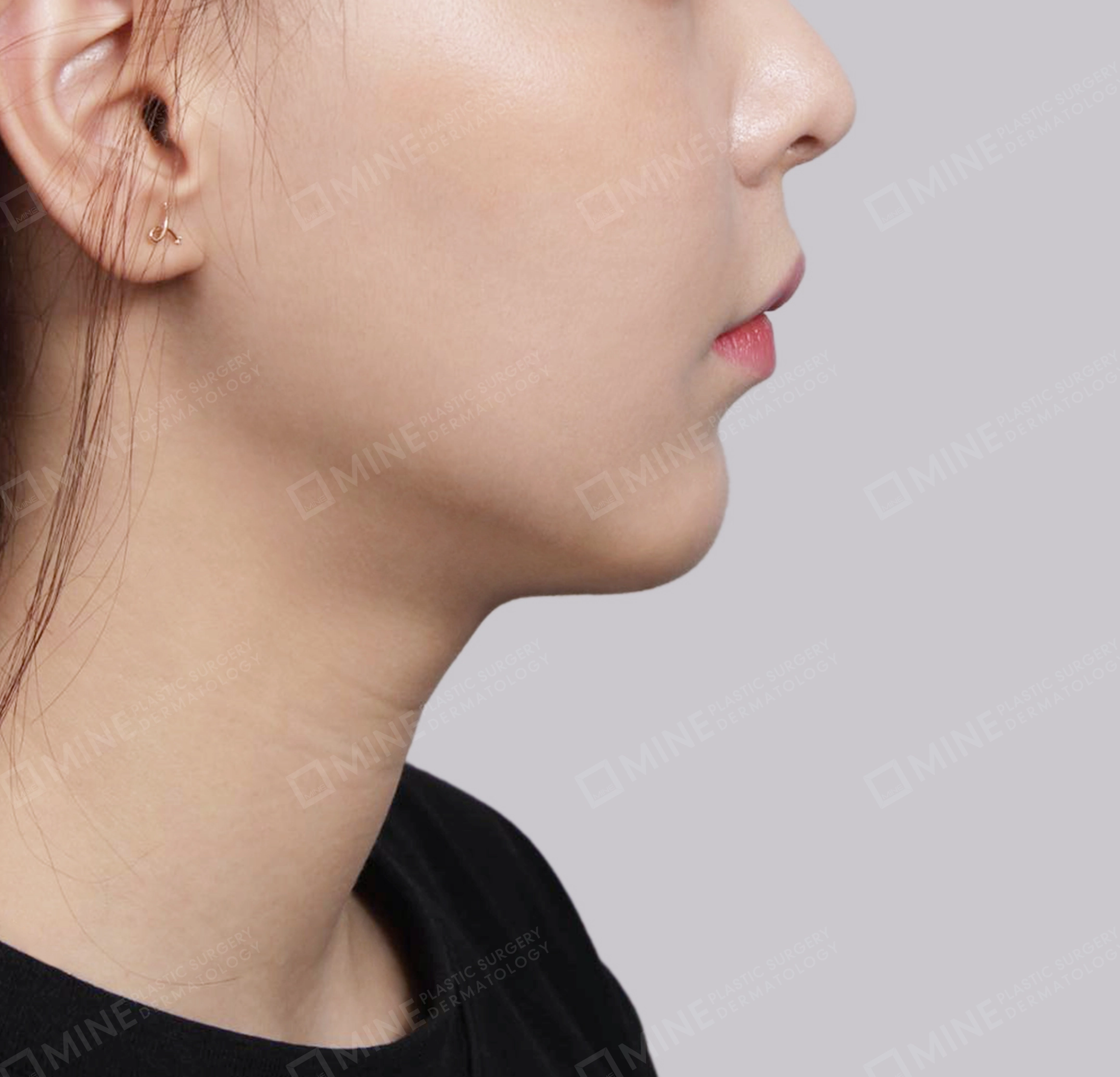 Double Chin (Vlimming)-측면-후