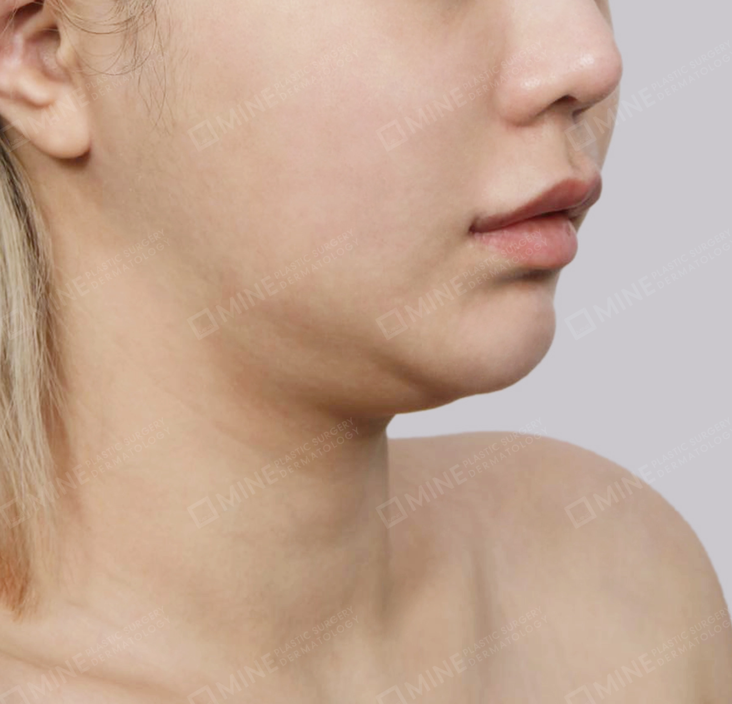 Double Chin (Vlimming)-정면-전