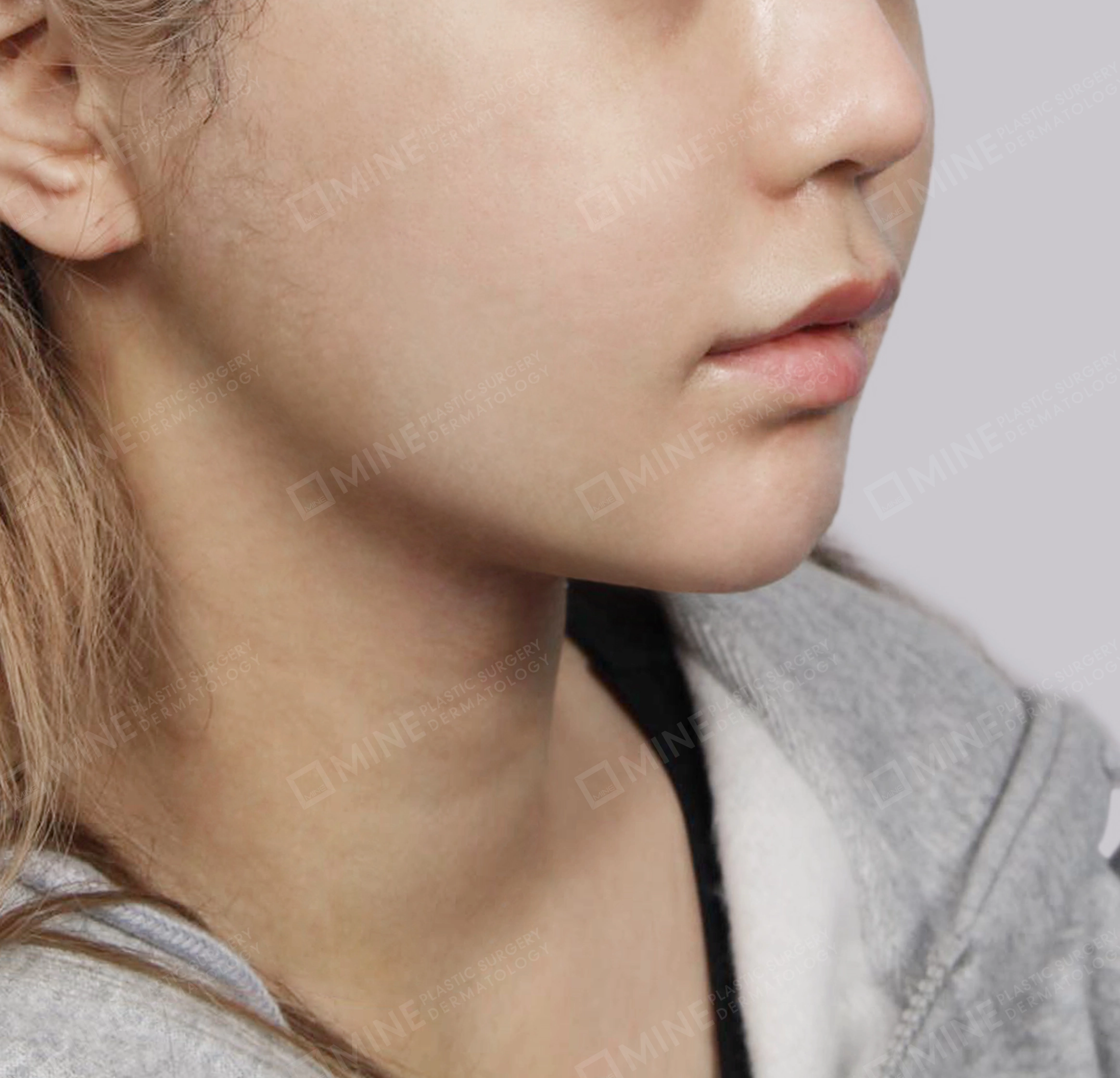 Double Chin (Vlimming)-정면-후