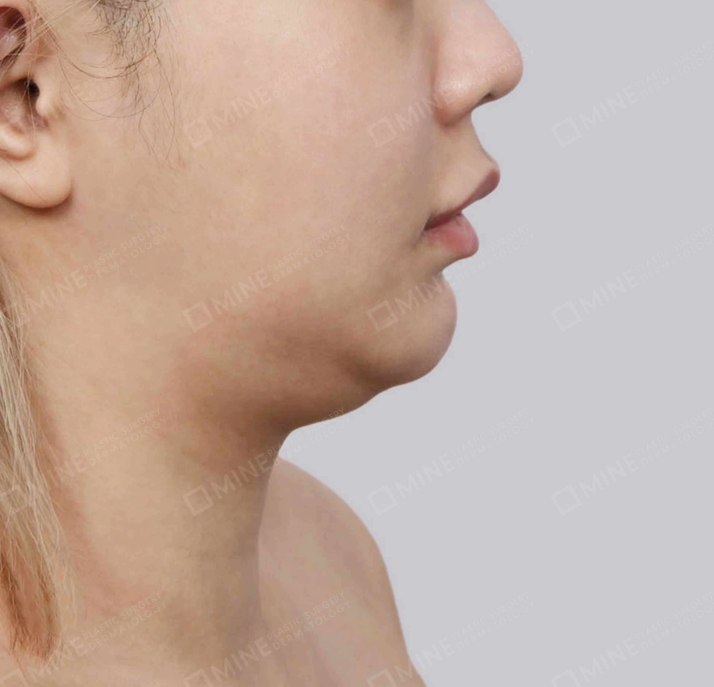Double Chin (Vlimming)-측면-전