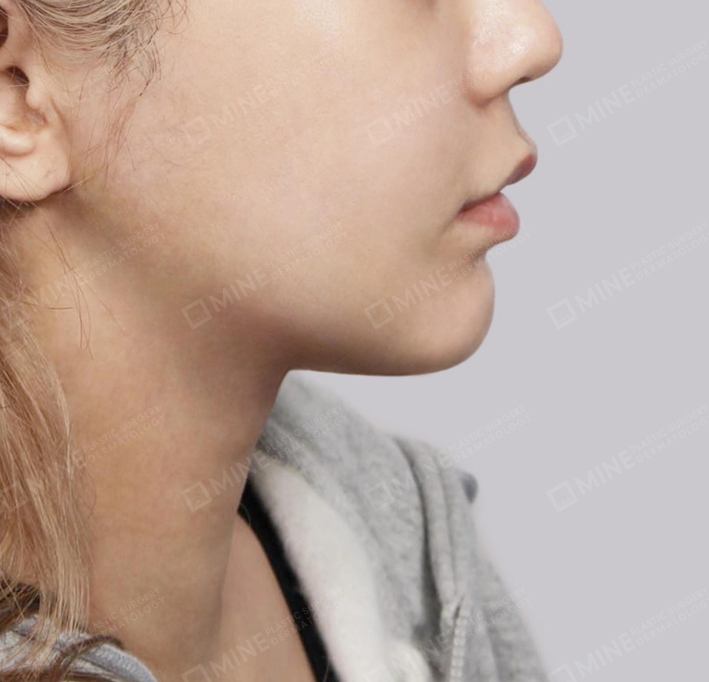 Double Chin (Vlimming)-측면-후