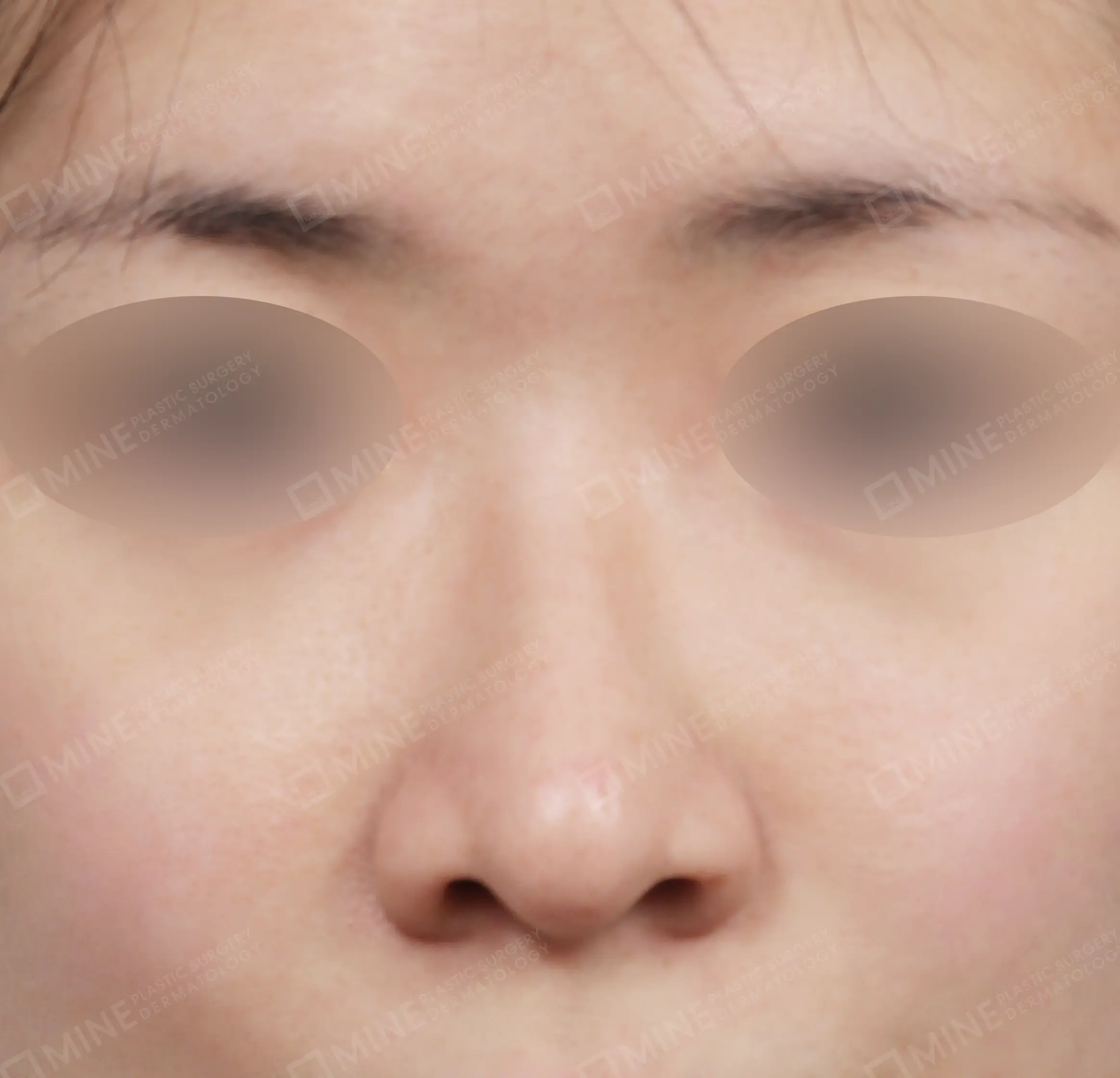 Hump Removal + Bridge + Tip Plasty + Alar Reduction + Tip Reduction-정면-전