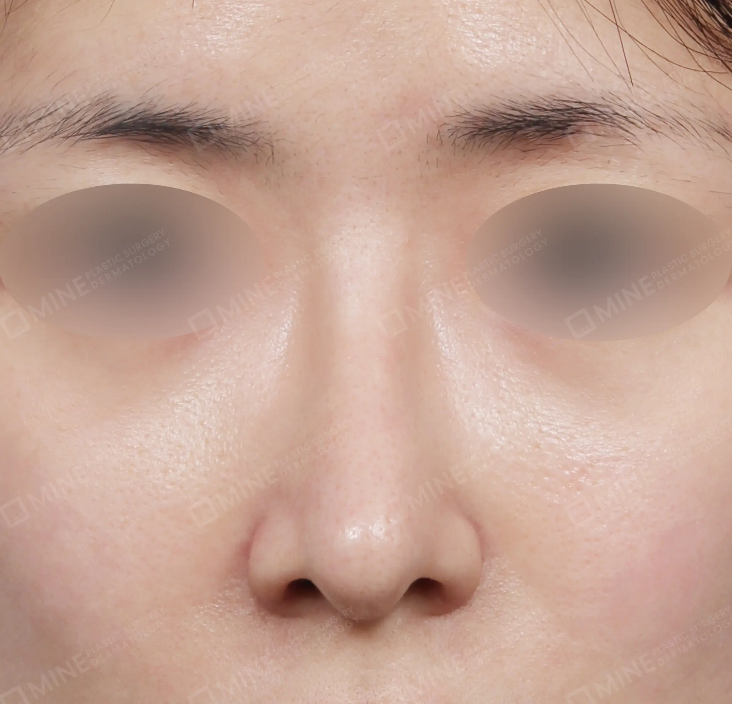 Hump Removal + Bridge + Tip Plasty + Alar Reduction + Tip Reduction-정면-후