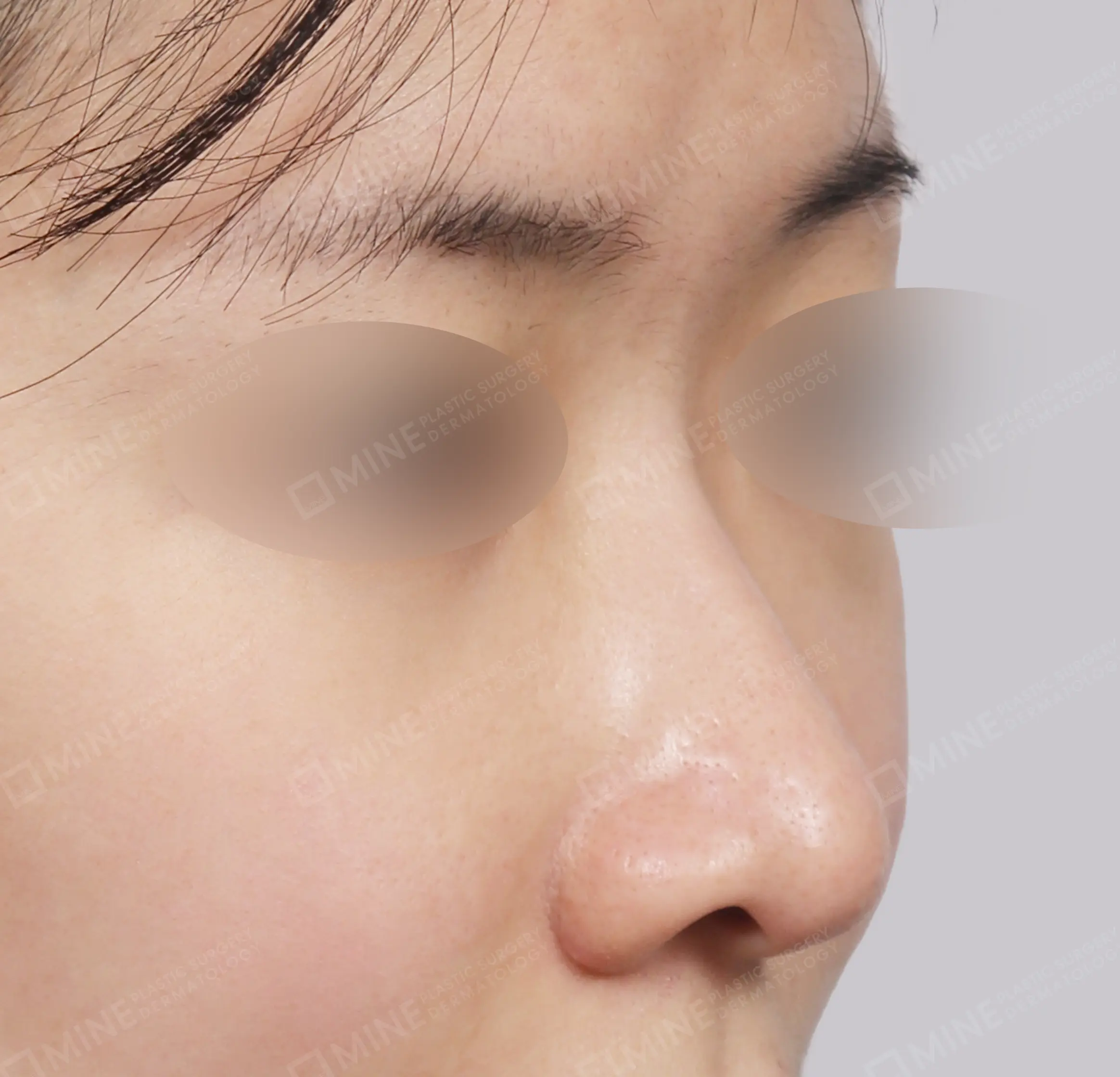 Hump Removal + Bridge + Tip Plasty + Alar Reduction + Tip Reduction-45도-전