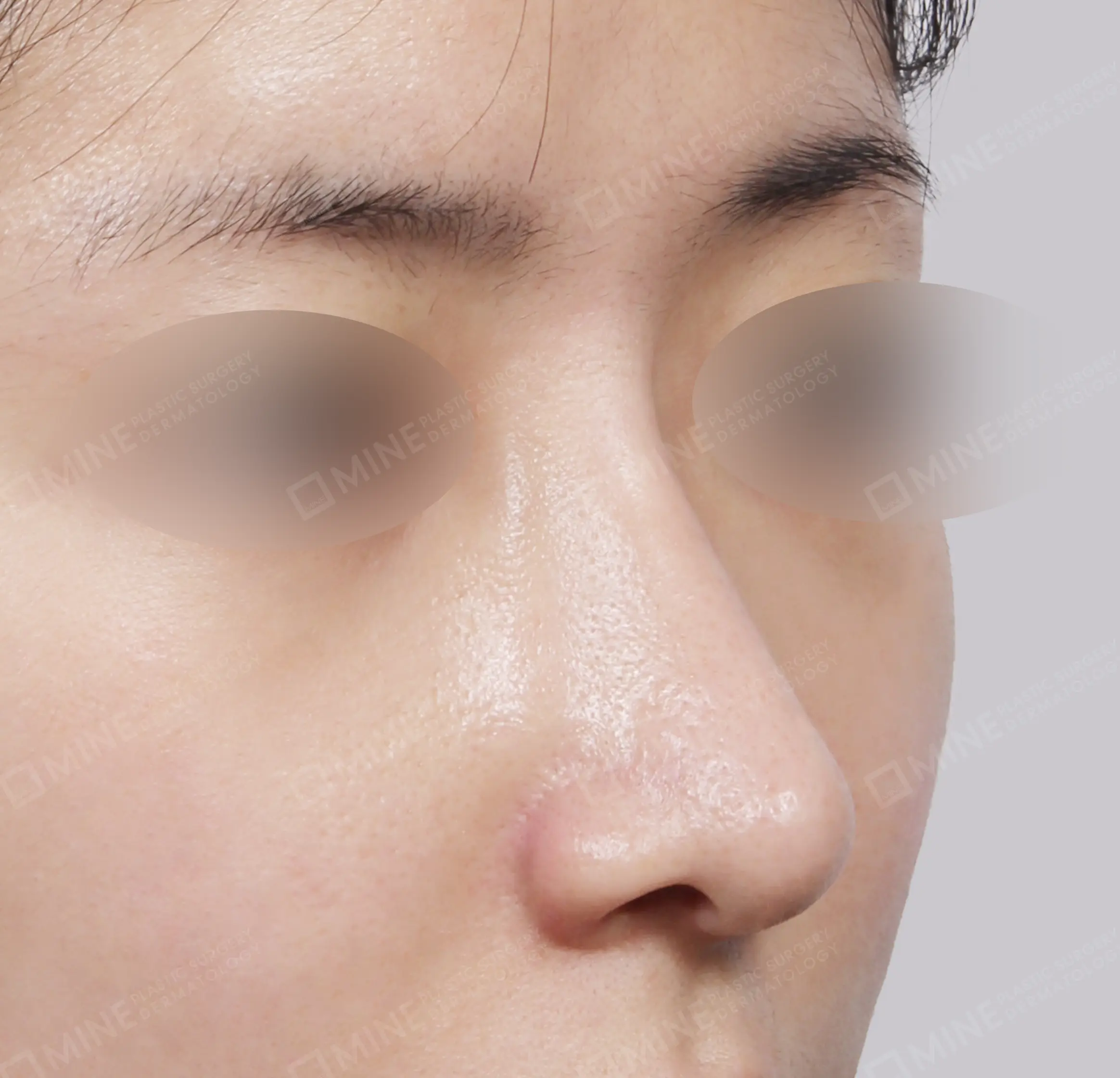 Hump Removal + Bridge + Tip Plasty + Alar Reduction + Tip Reduction-45도-후