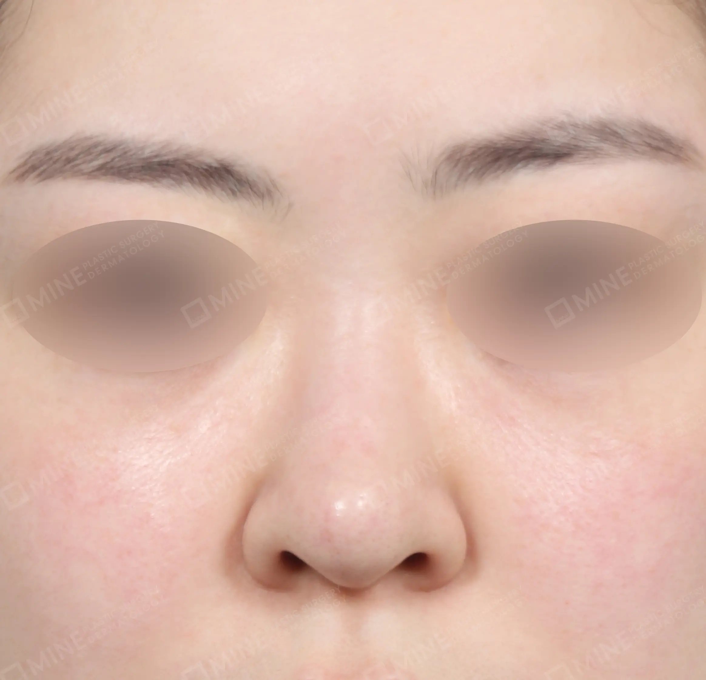 Revision Rhinoplasty-정면-전