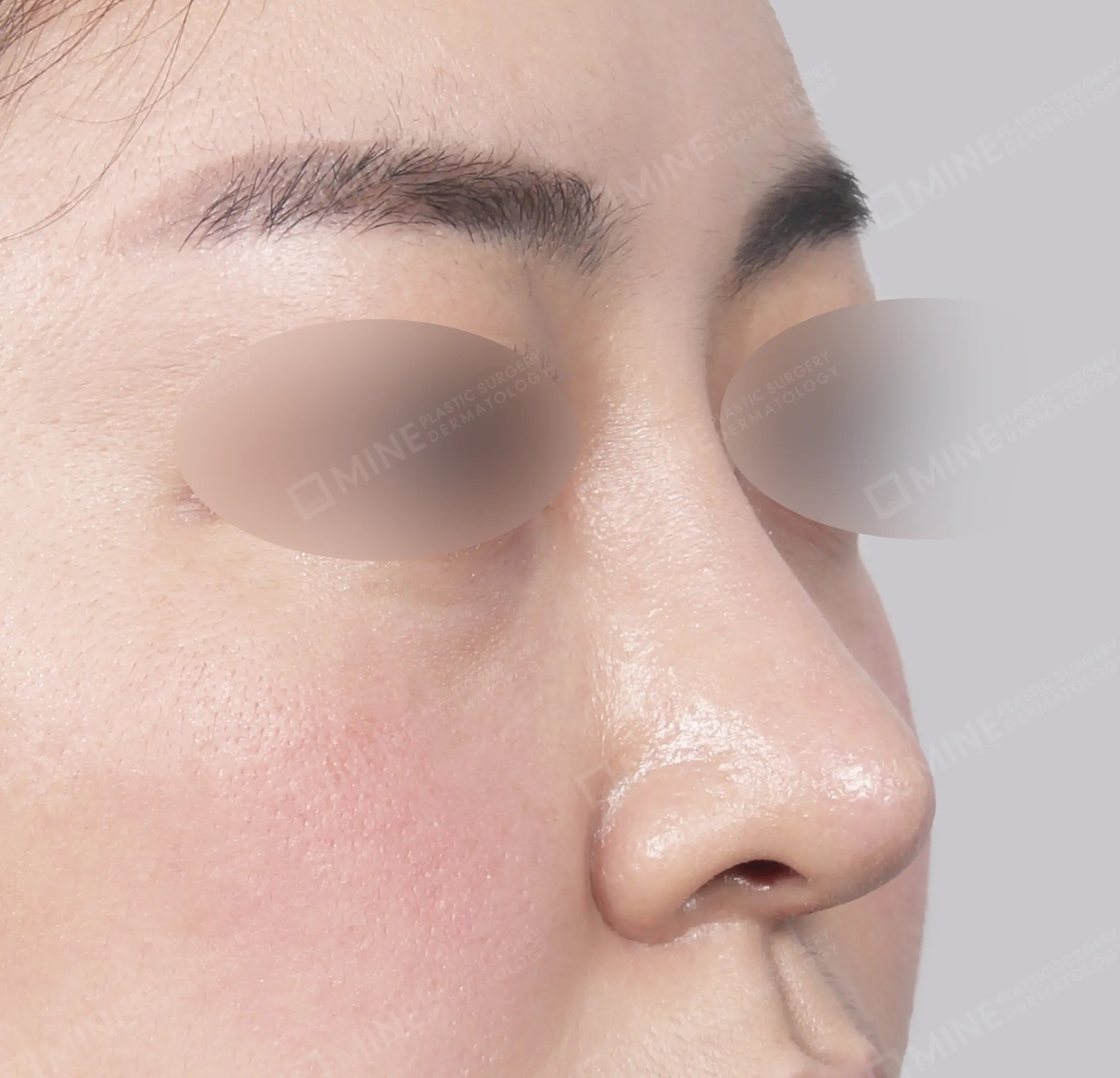 Revision Rhinoplasty-45도-후