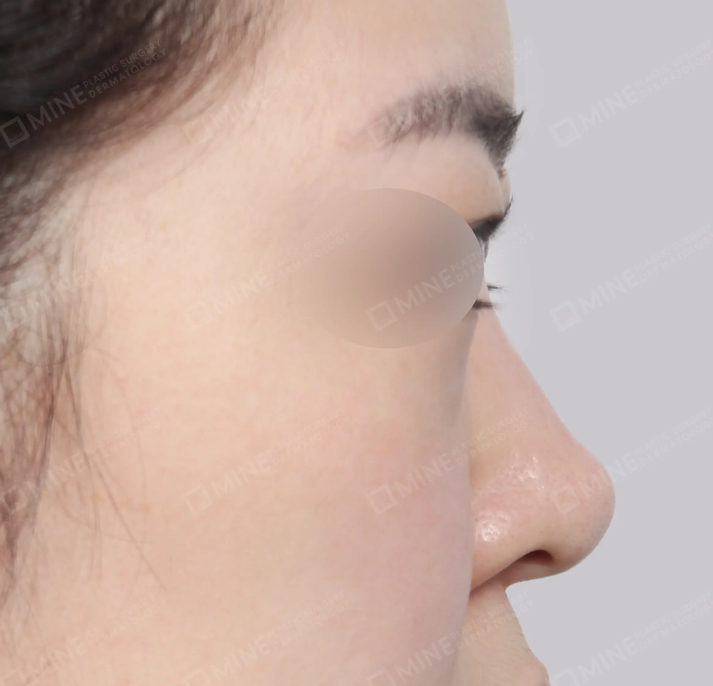 Revision Rhinoplasty-측면-전