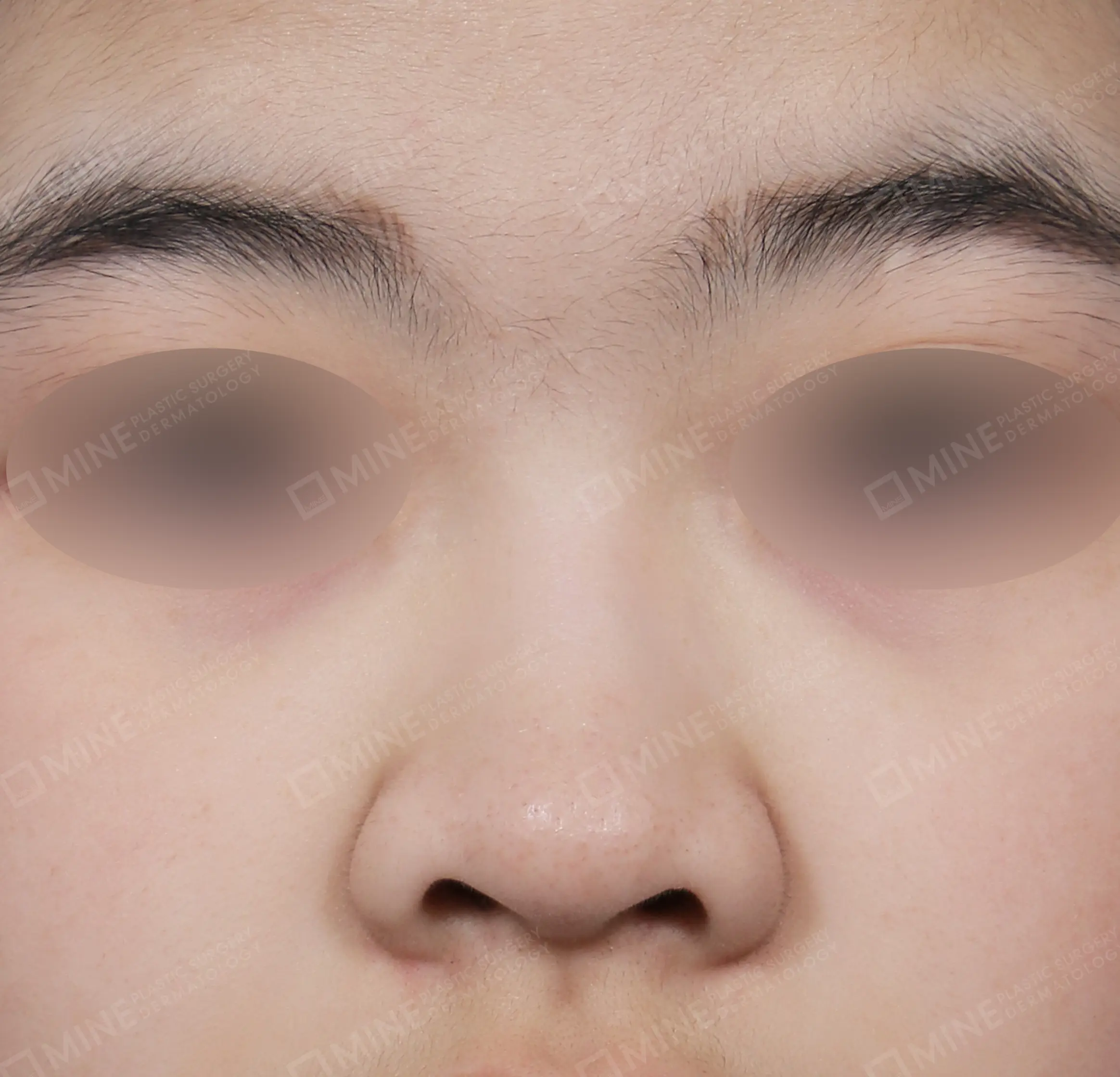 Bridge + Septal Extension + Tip Reduction + Alar Reduction-정면-전