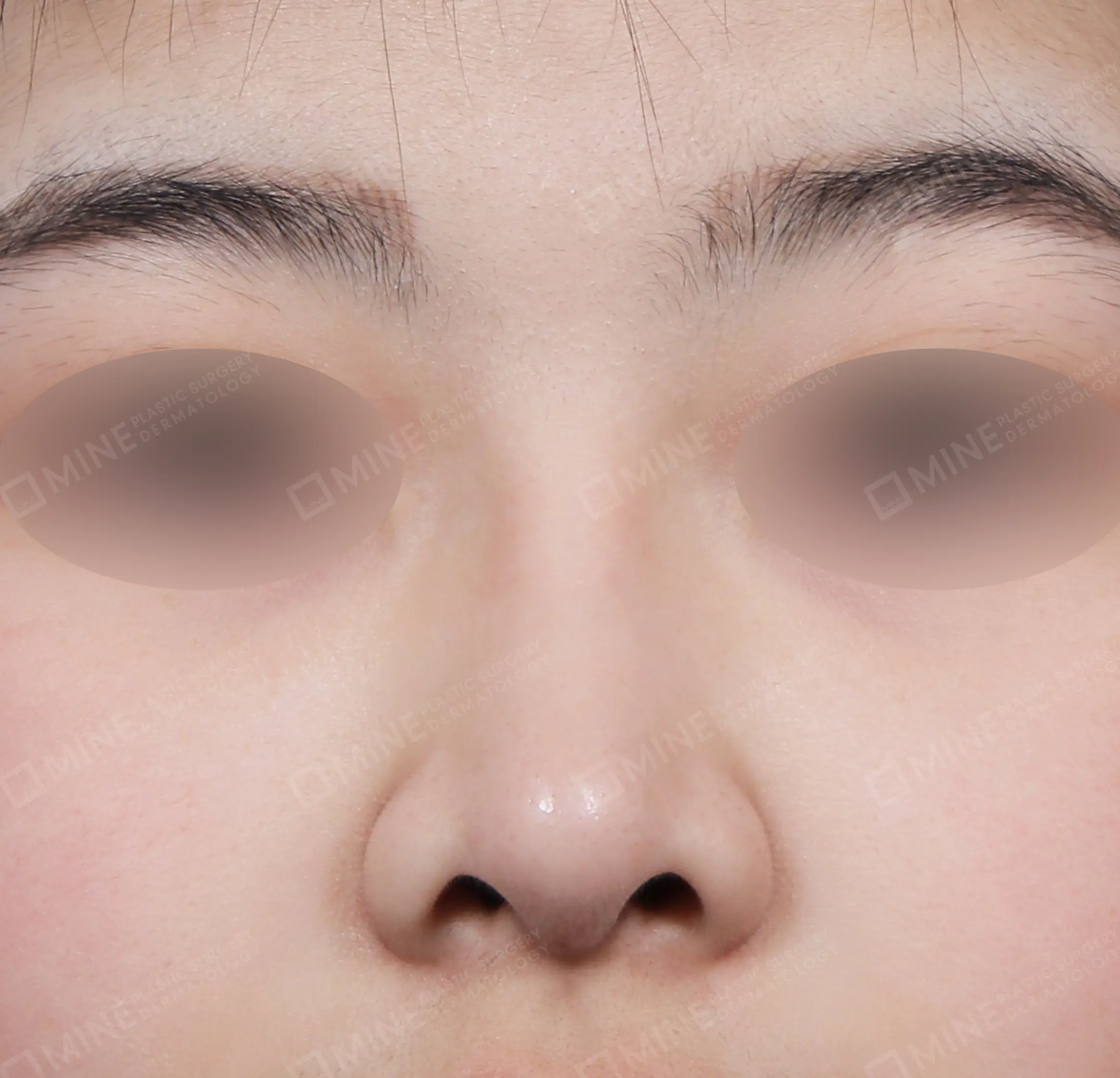 Bridge + Septal Extension + Tip Reduction + Alar Reduction-정면-후