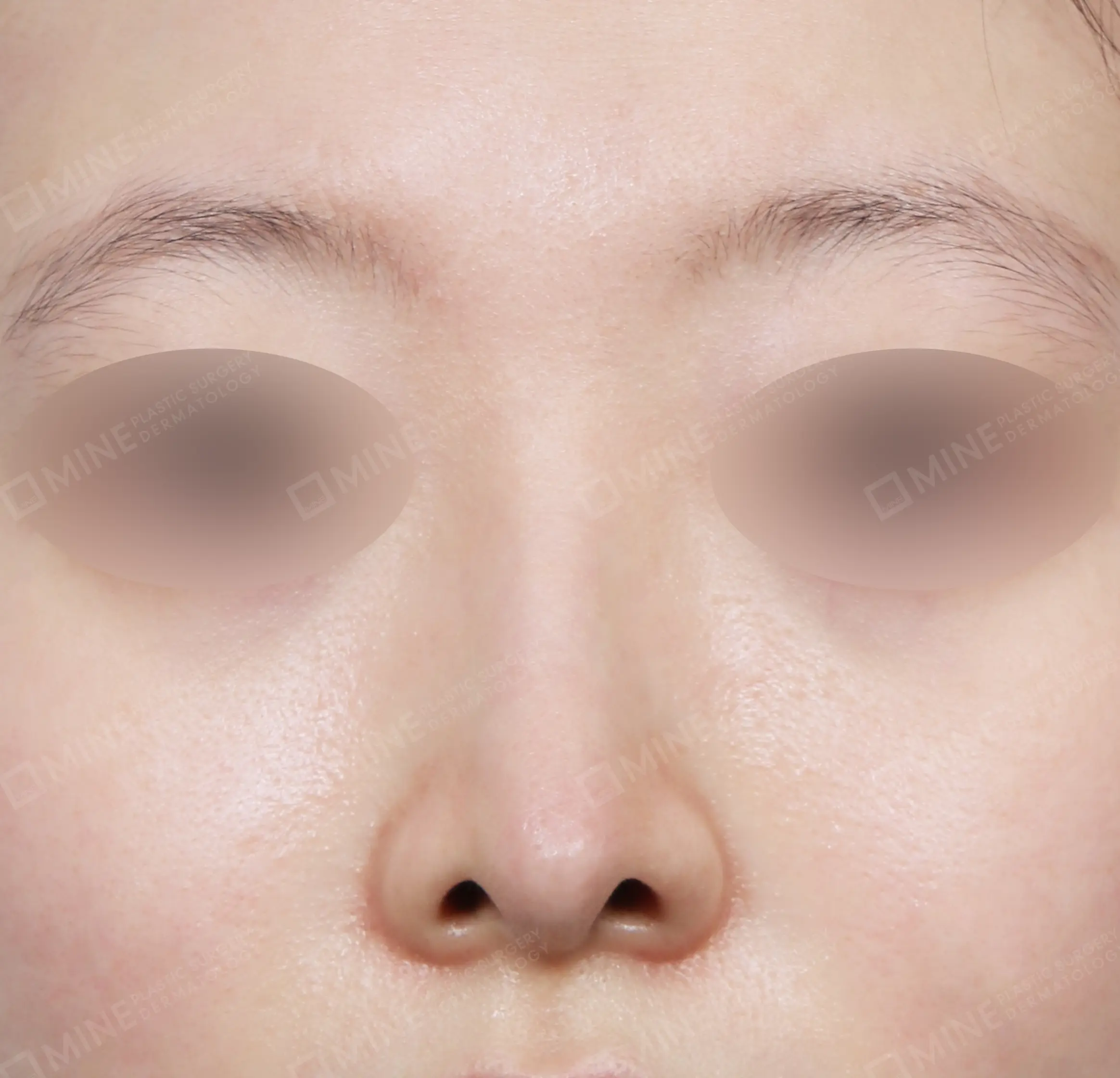 Hump Removal + Deviation Correctrion + Bridge + Tip Plasty-정면-후