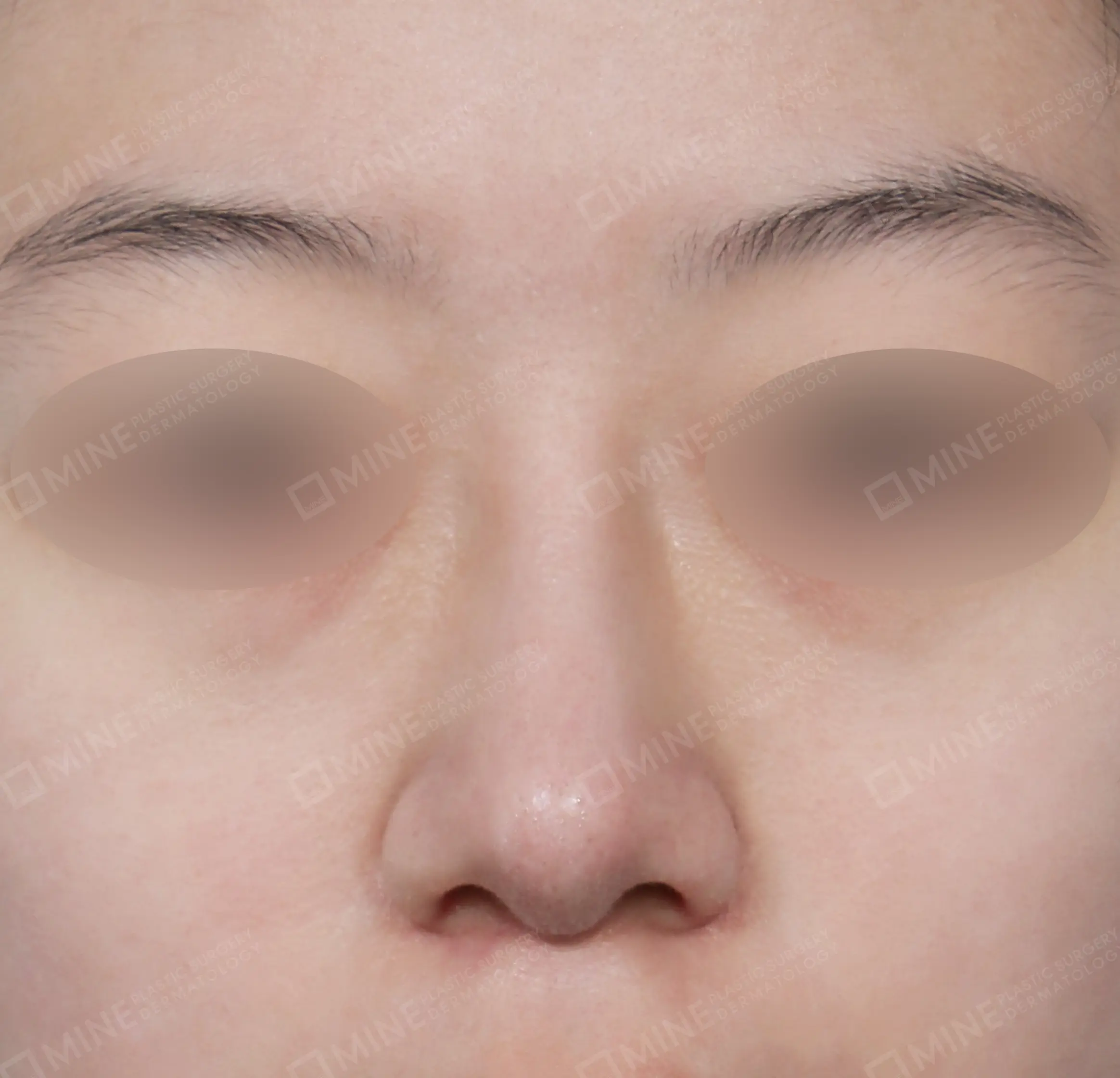 Bridge + Tip Reduction + Alar Reduction-정면-후