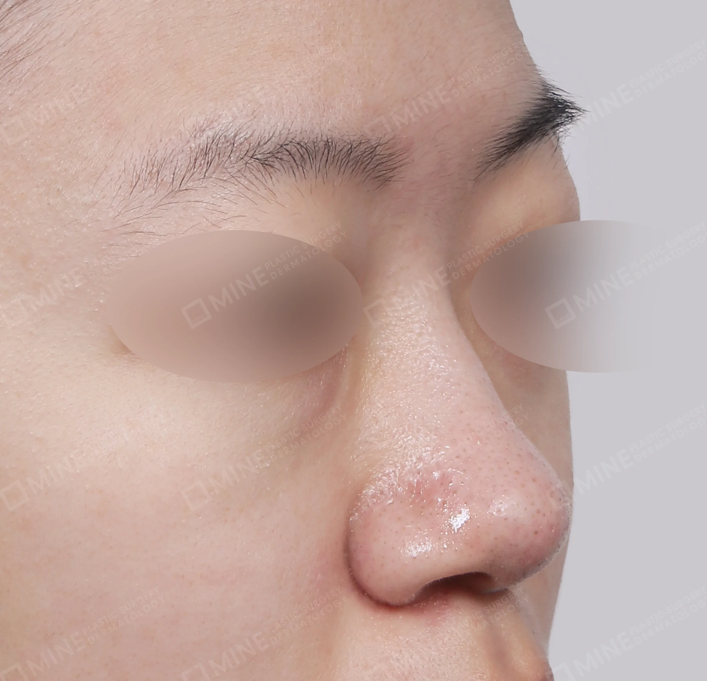 Bridge + Tip Reduction + Alar Reduction-45도-전