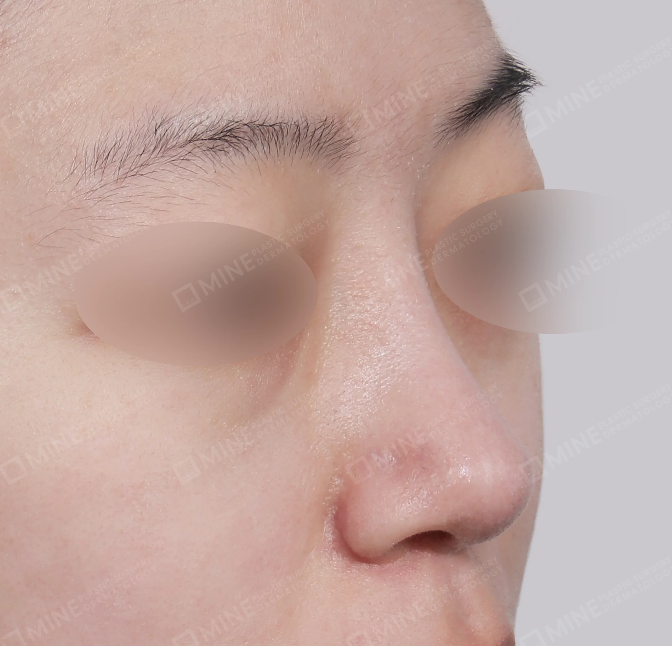 Bridge + Tip Reduction + Alar Reduction-45도-후