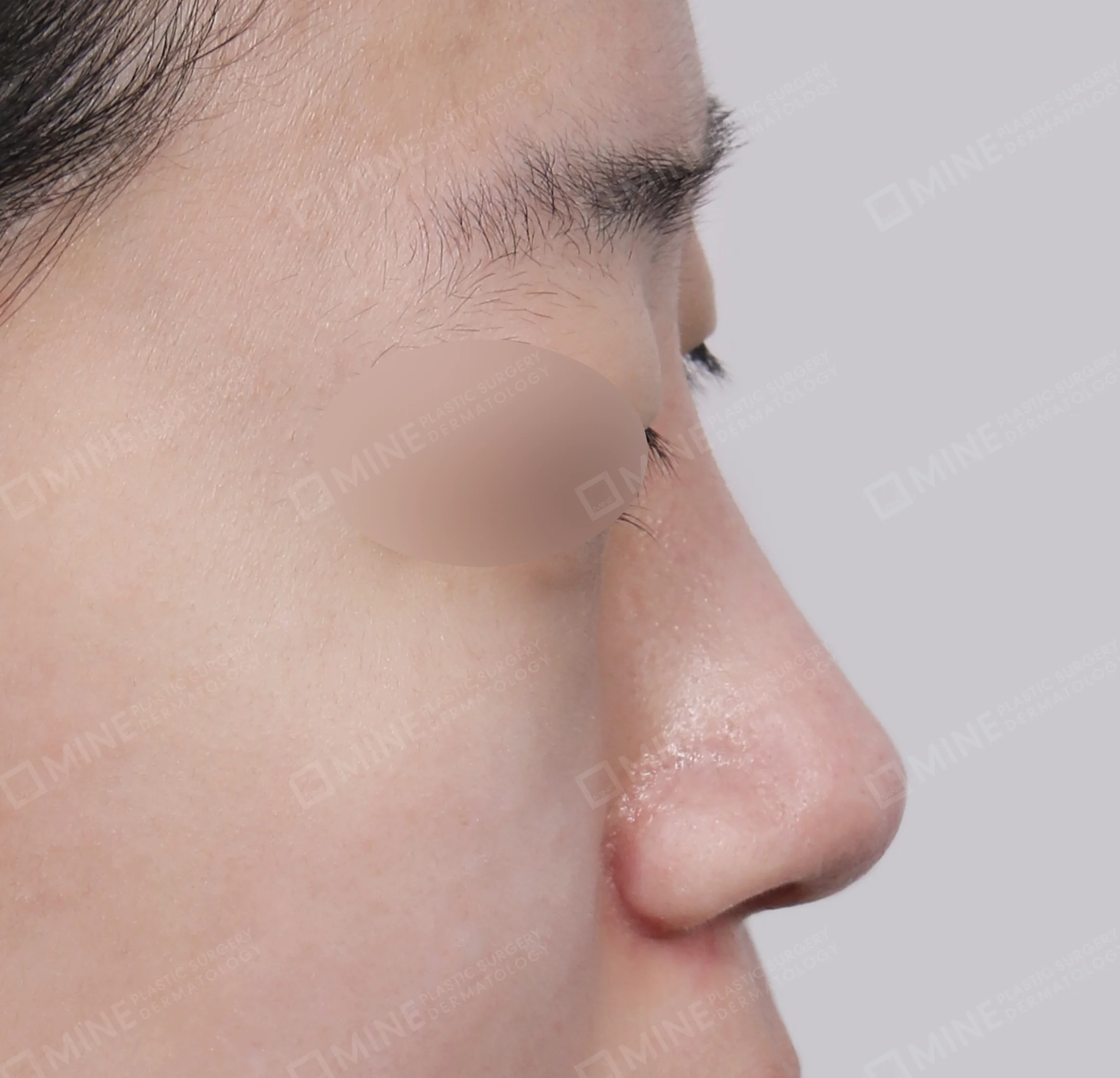 Bridge + Tip Reduction + Alar Reduction-측면-후