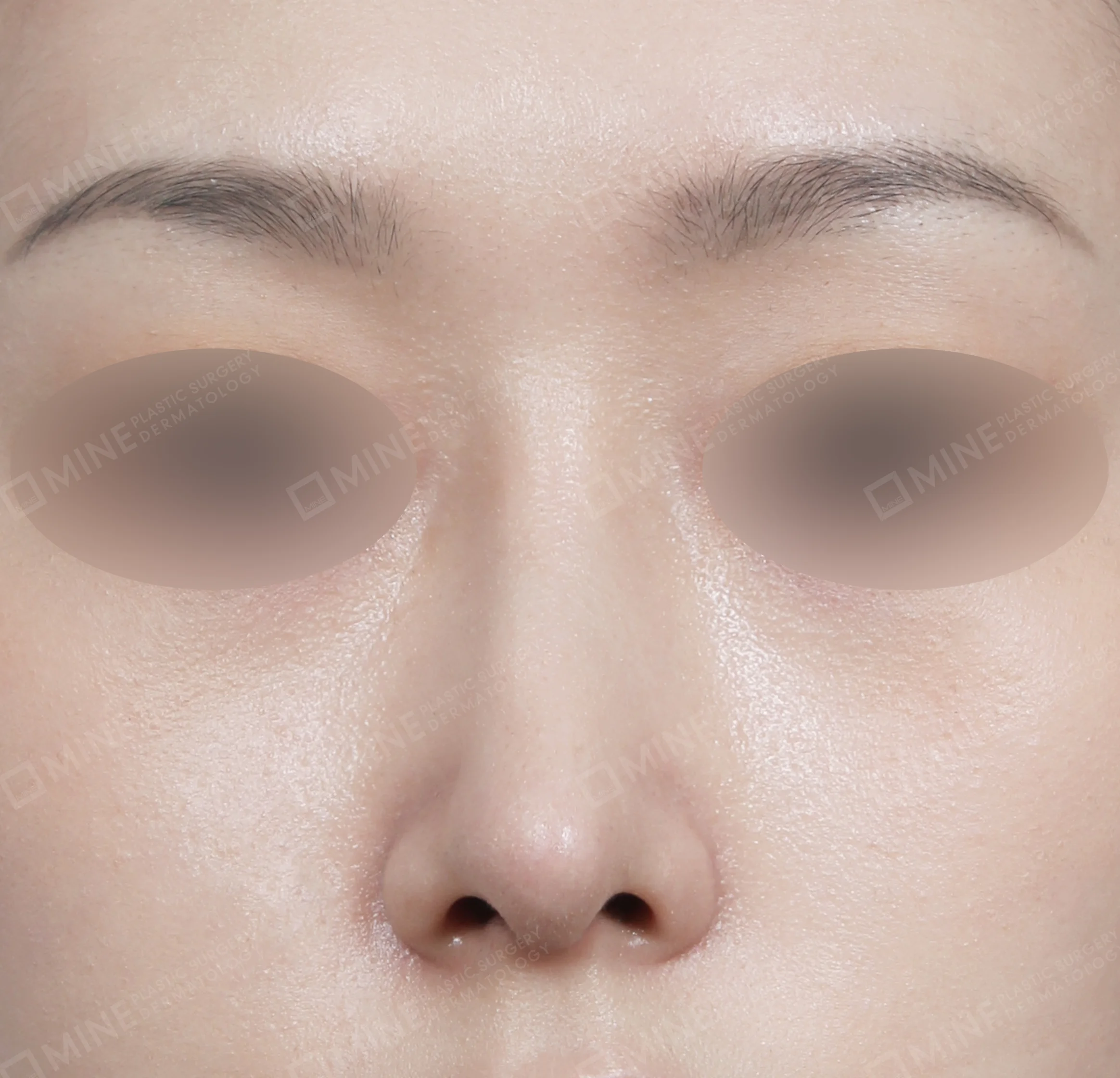 Hump Removal + Bridge + Septal Extension-정면-후