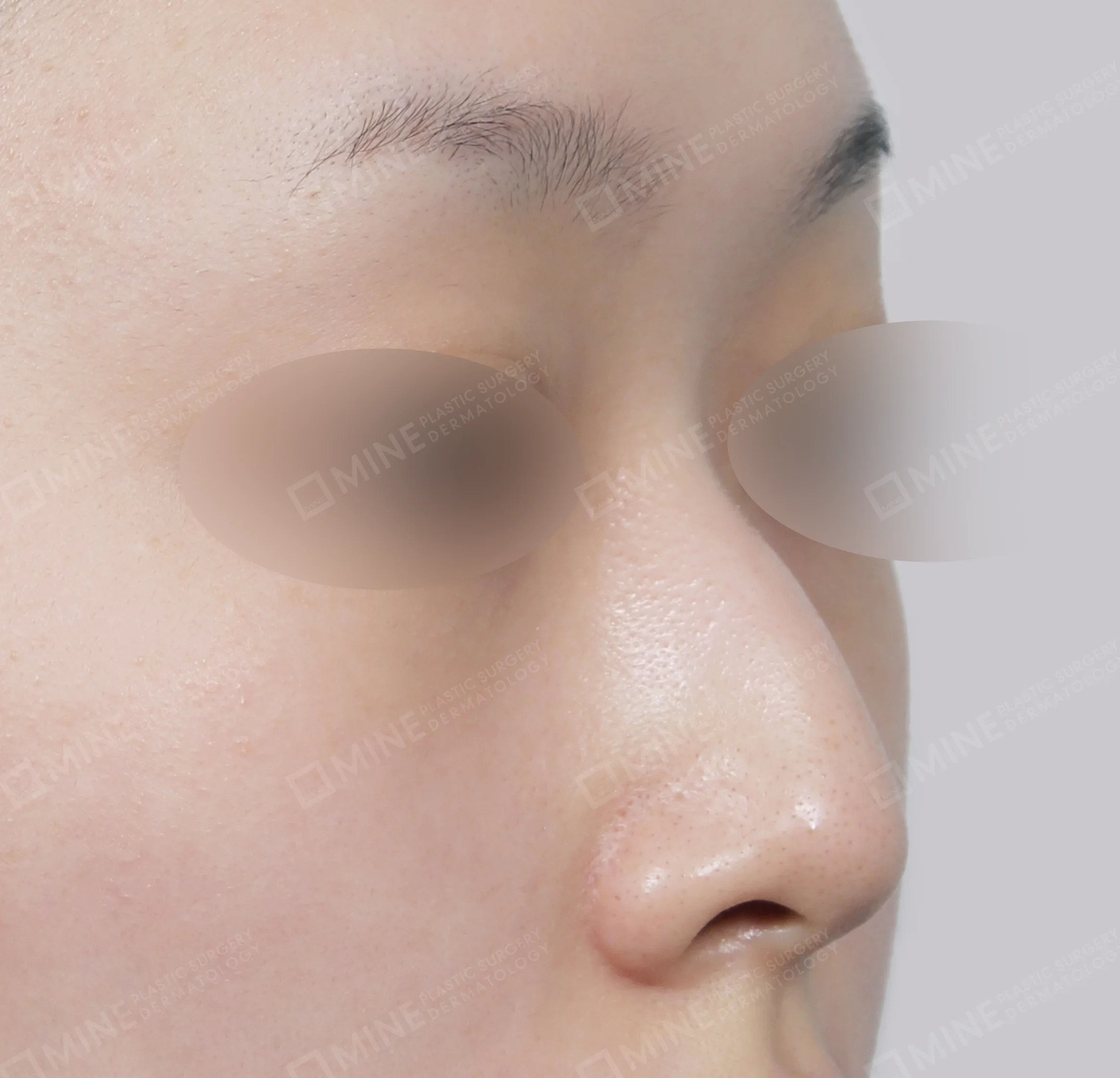 Hump Removal + Bridge + Septal Extension-45도-전