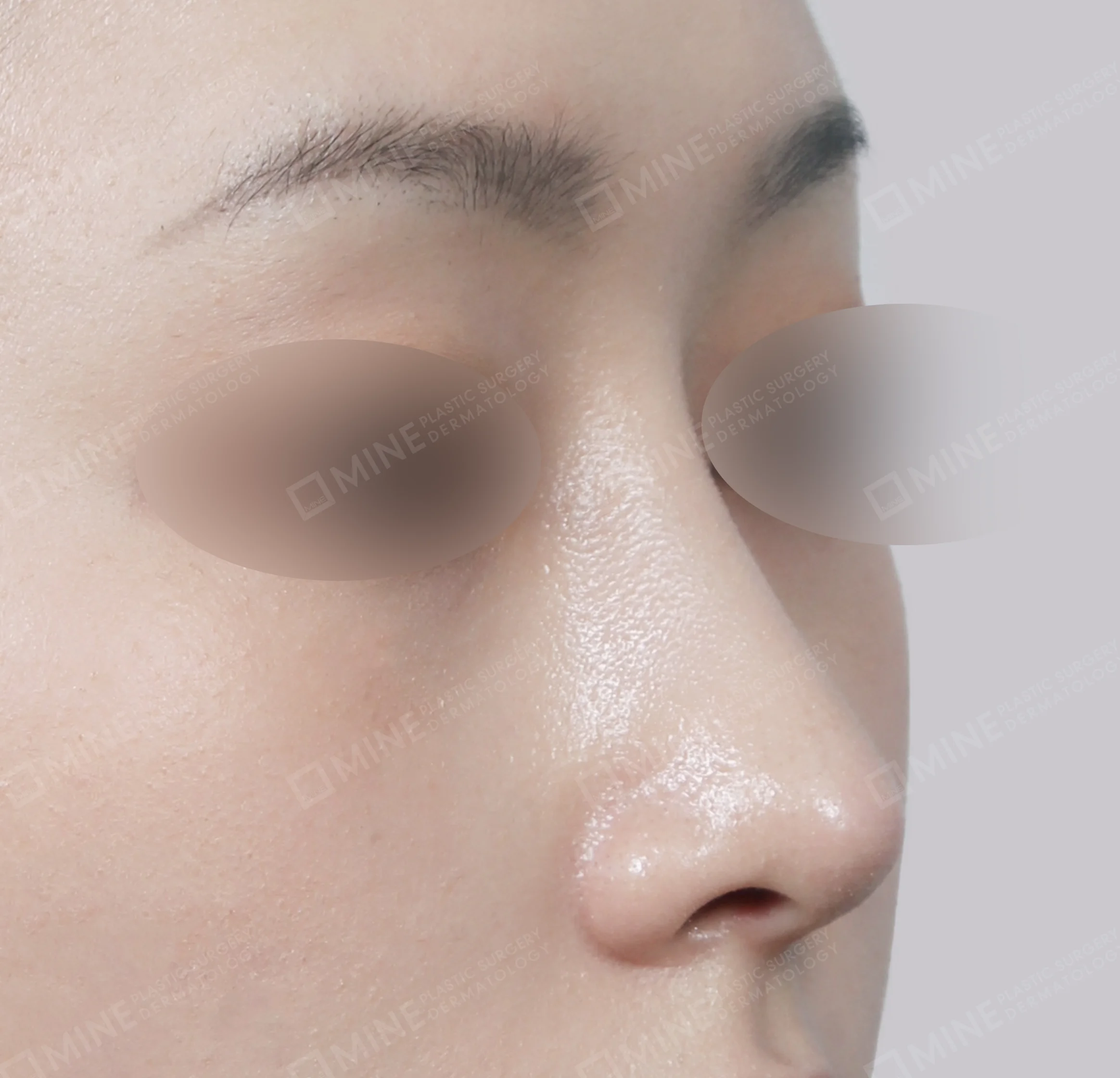 Hump Removal + Bridge + Septal Extension-45도-후