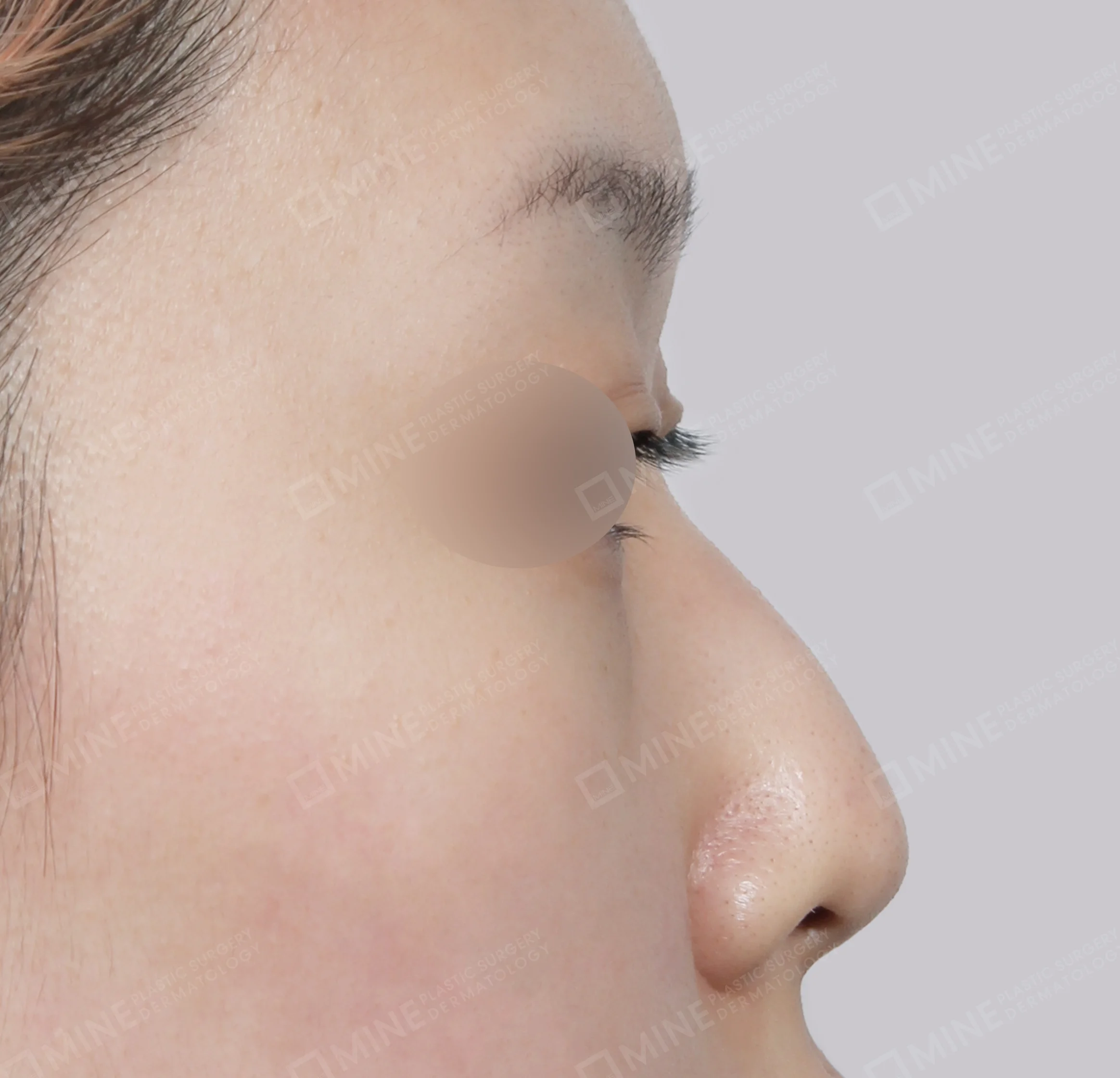 Hump Removal + Bridge + Septal Extension-측면-전