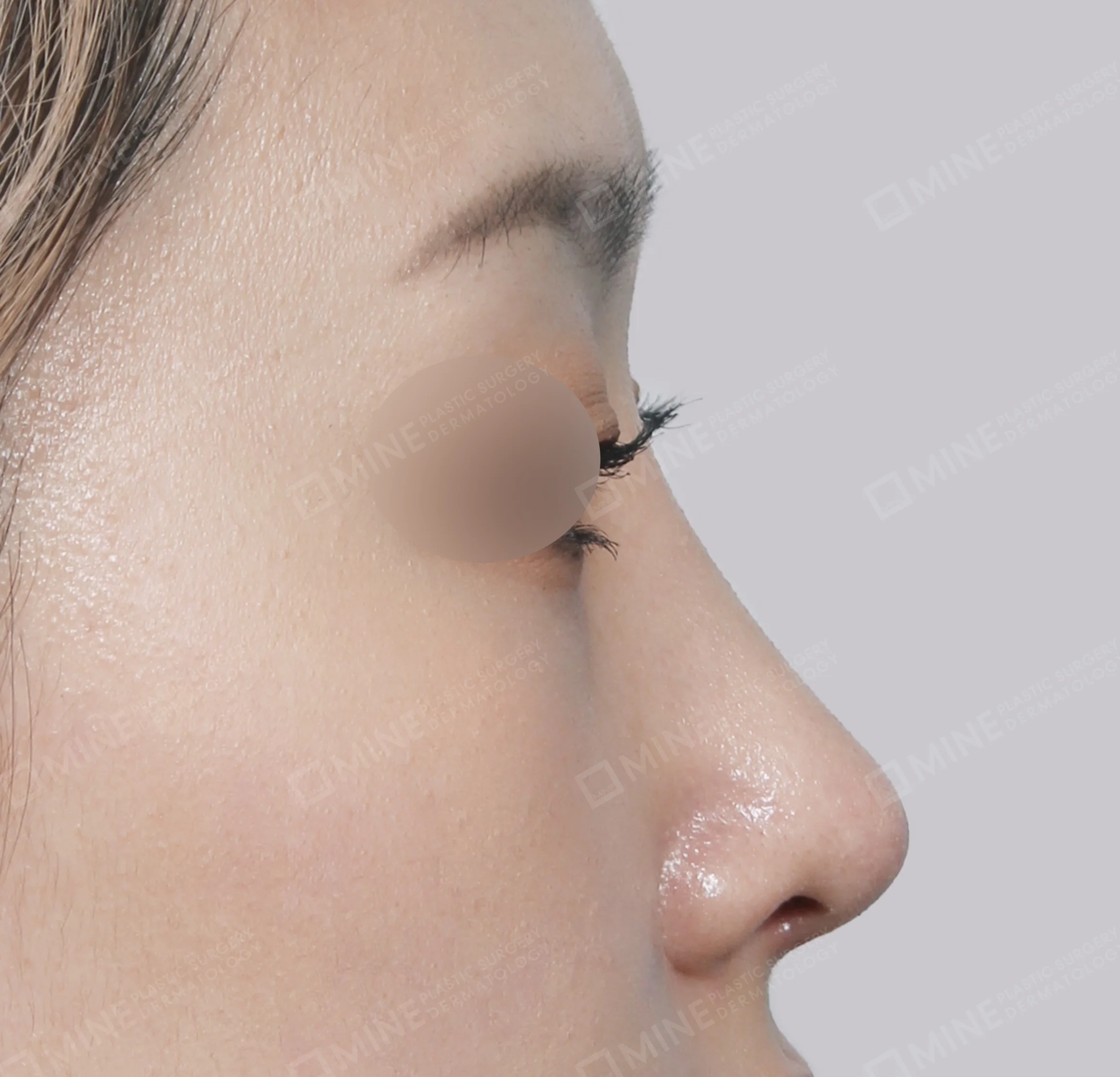 Hump Removal + Bridge + Septal Extension-측면-후