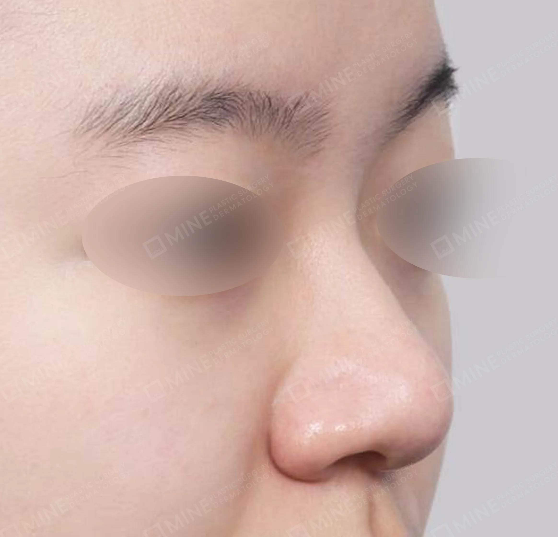 Hump Removal + Osteotomy + Alar Reduction + Tip Plasty-45도-전