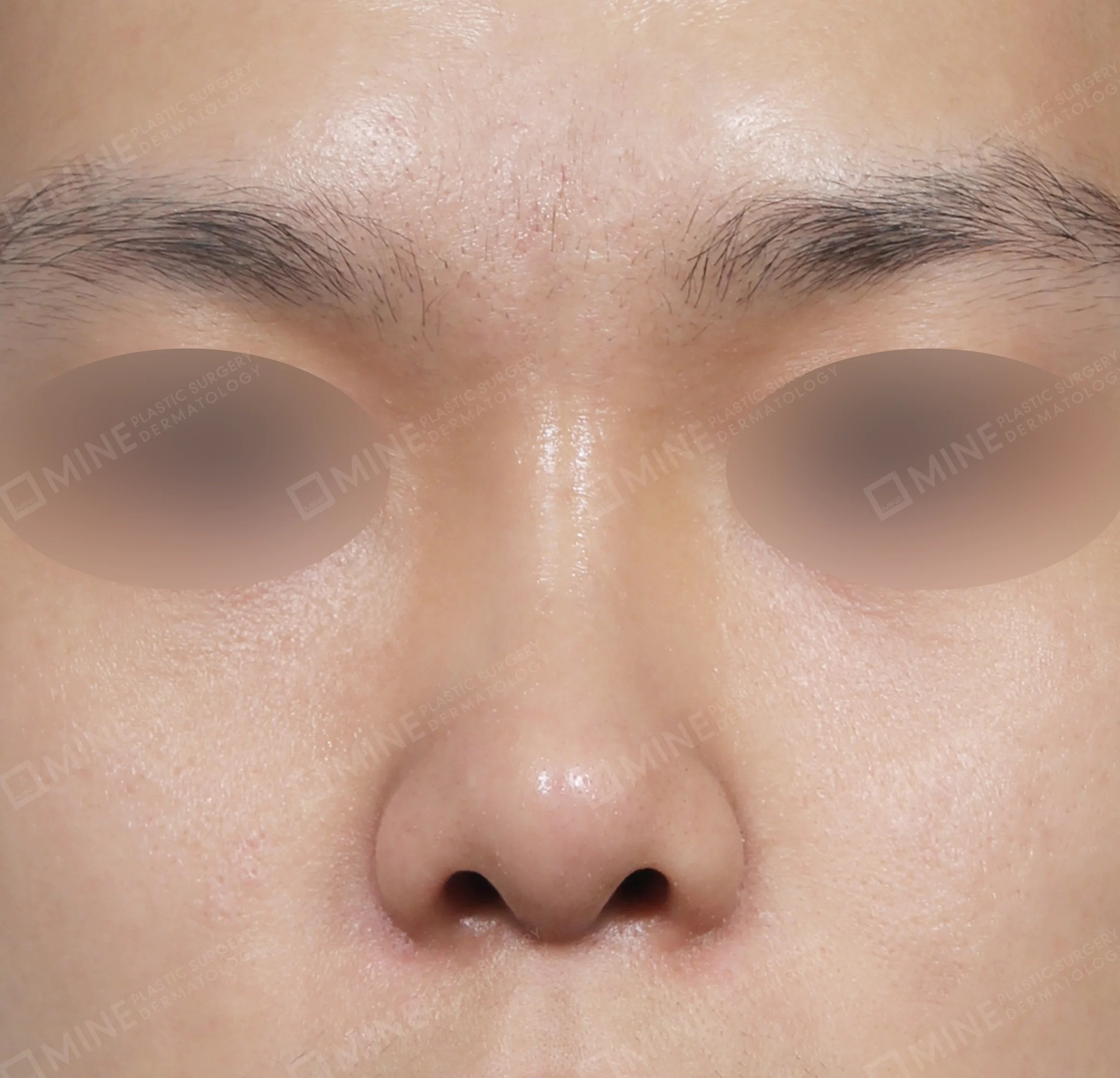 Hump Removal + Bridge + Septal Extension + Tip Reduction-정면-후