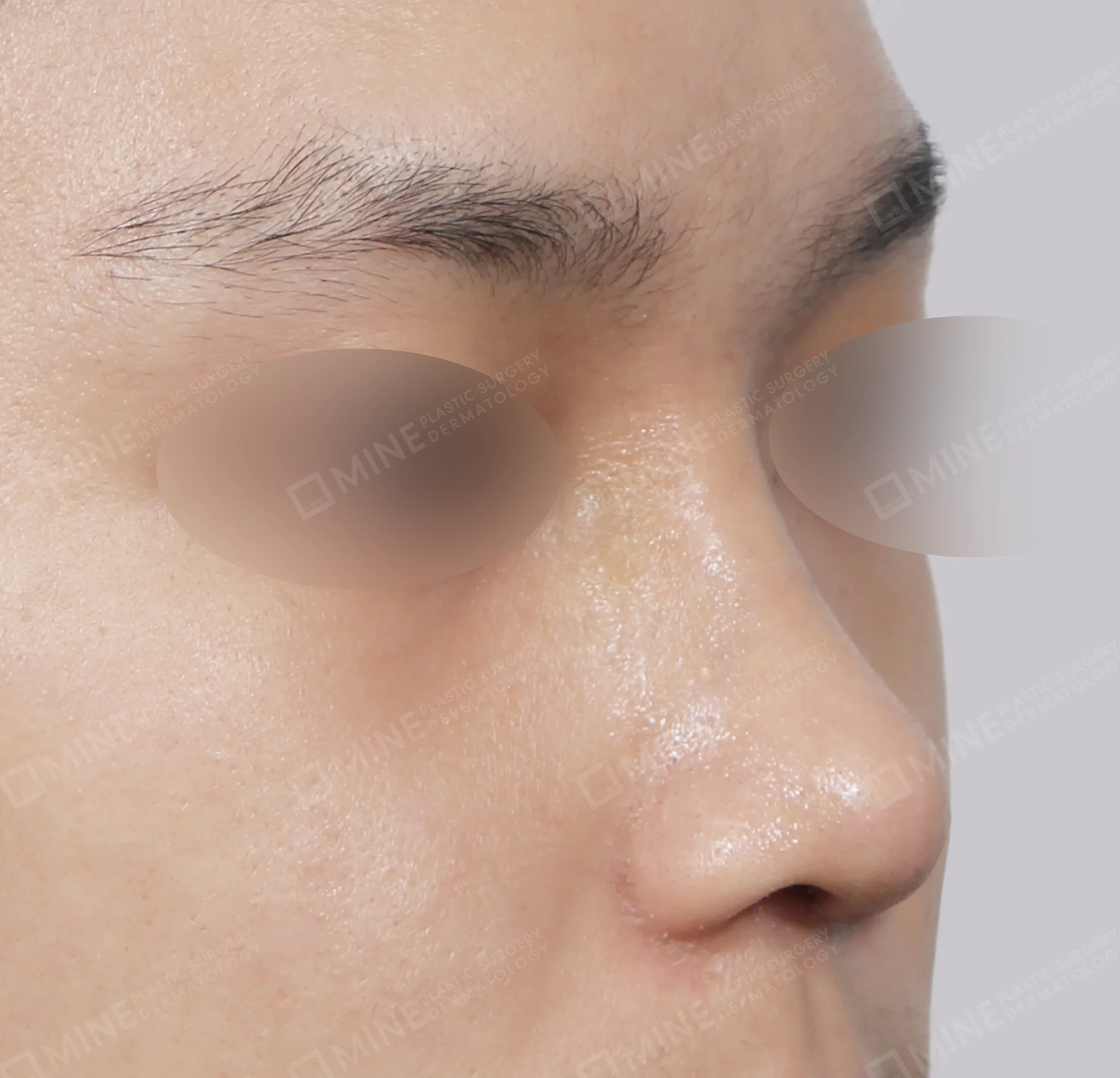 Hump Removal + Bridge + Septal Extension + Tip Reduction-45도-후