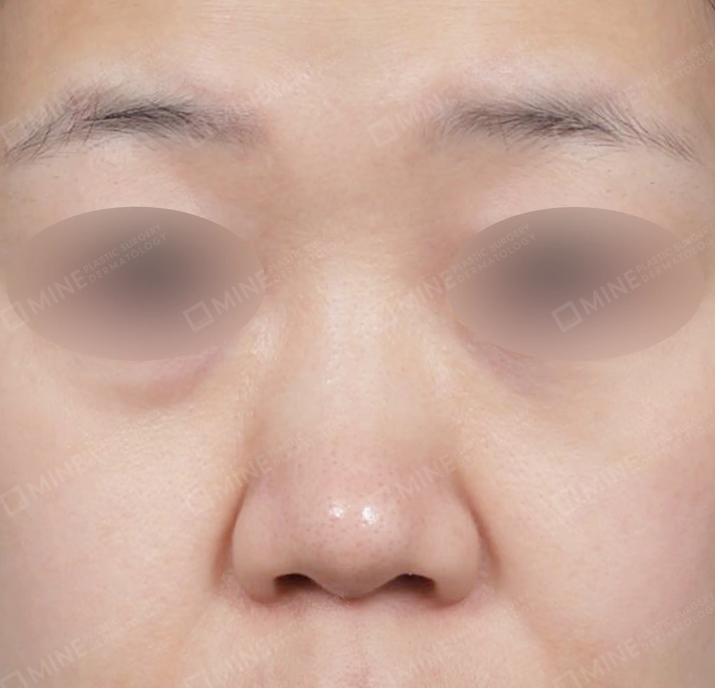 Bridge + Tip Reduction + Alar Reduction + Septal Extension-정면-전