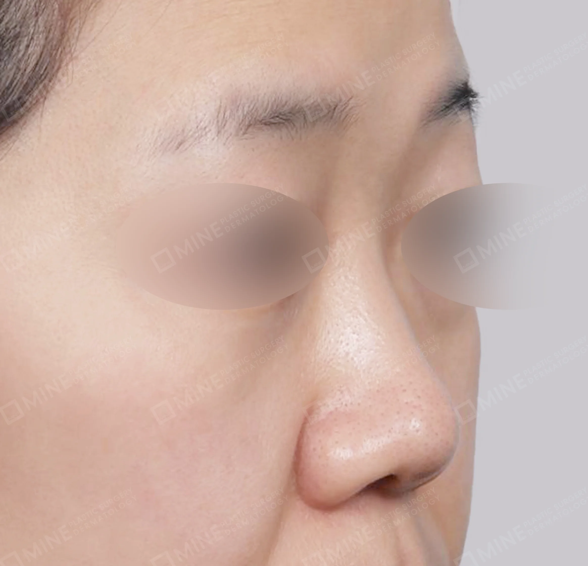 Bridge + Tip Reduction + Alar Reduction + Septal Extension-45도-전