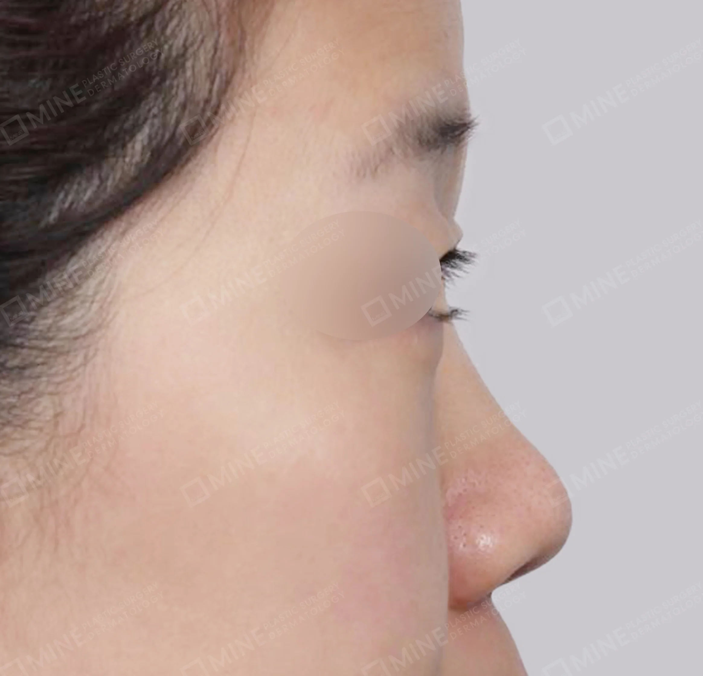 Bridge + Tip Reduction + Alar Reduction + Septal Extension-측면-전