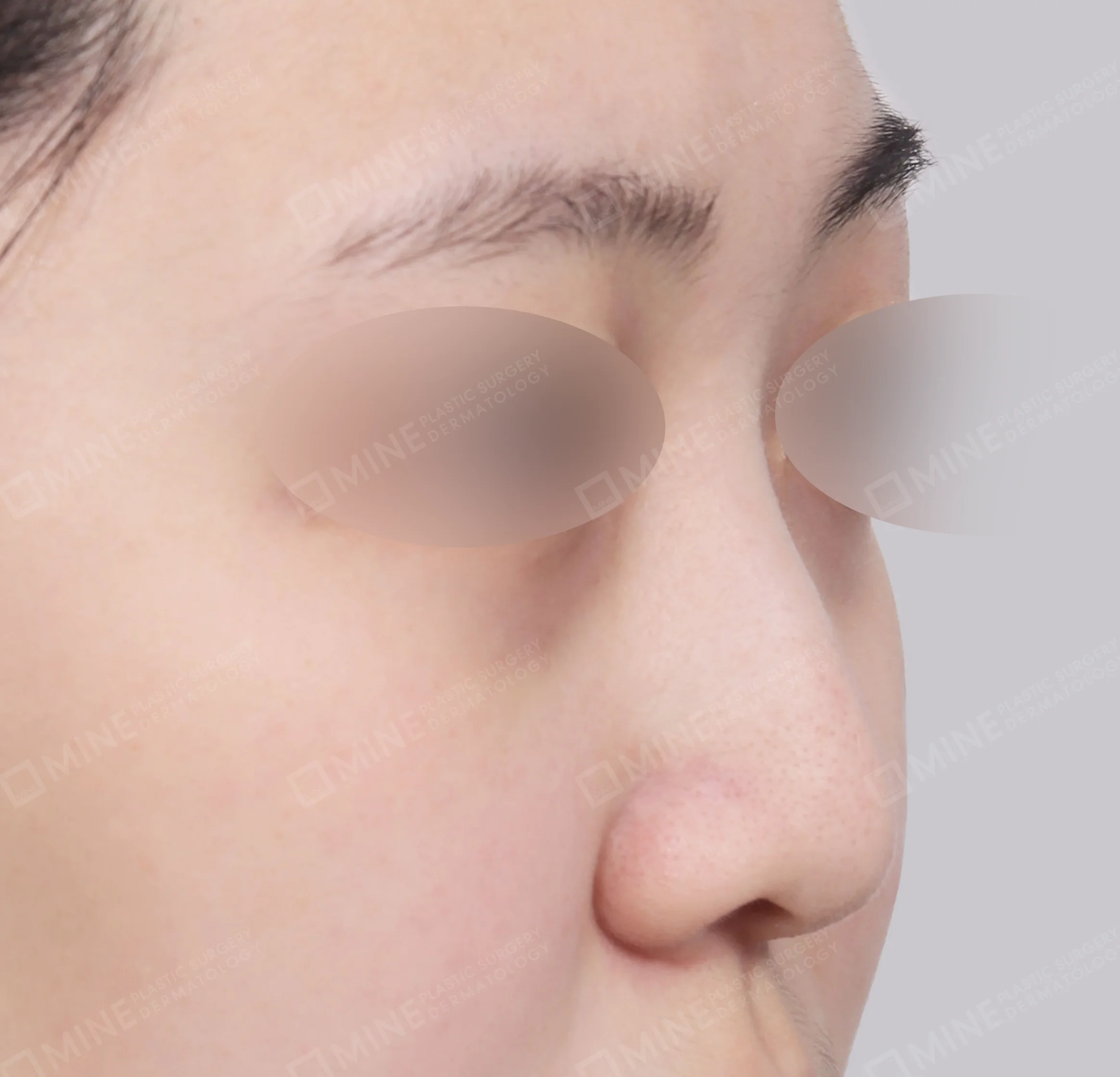 Deviation Correction + Osteotomy + Tip Plasty-정면-전