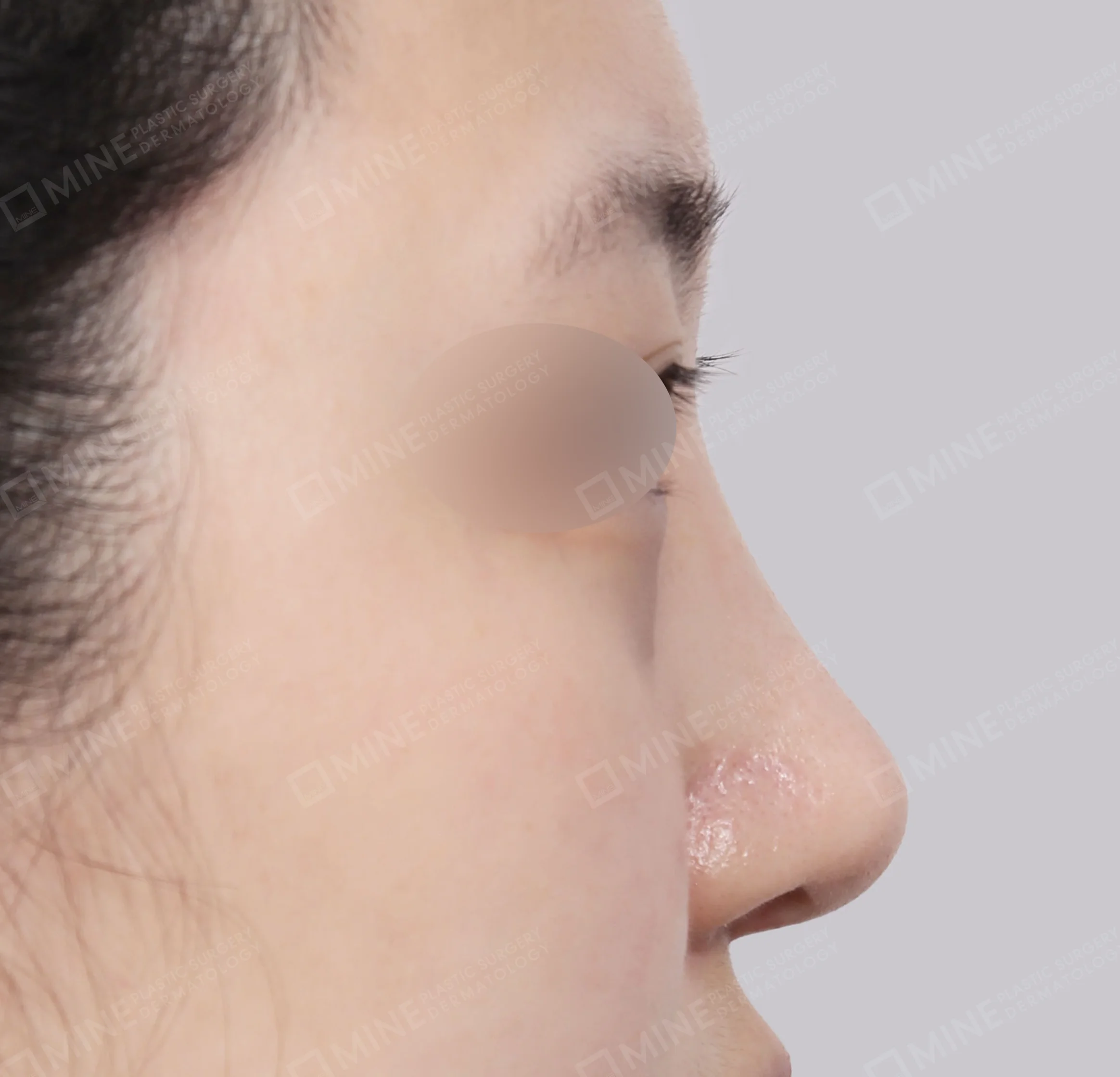 Deviation Correction + Osteotomy + Tip Plasty-측면-후