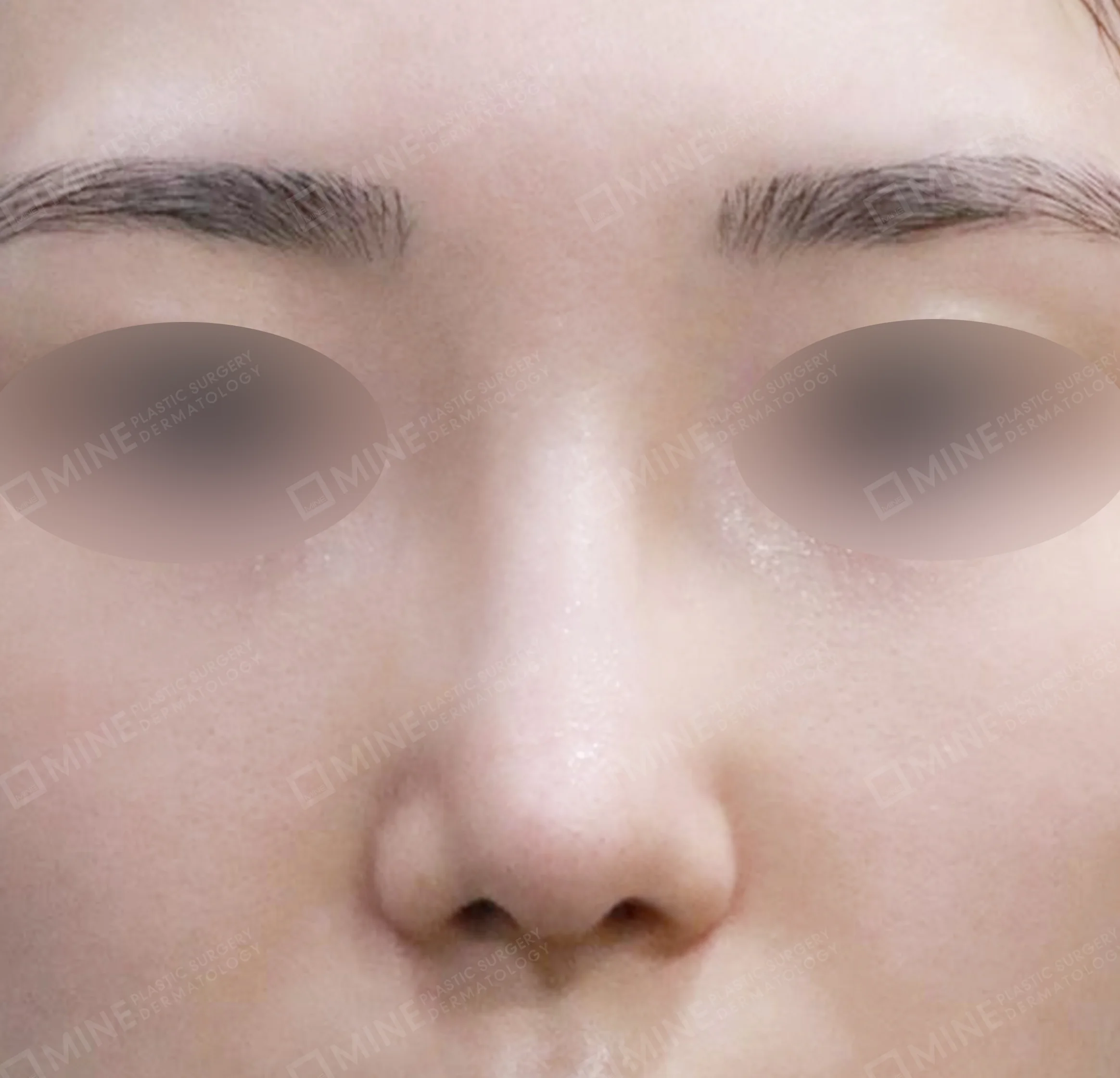 Revision Rhinoplasty-정면-후