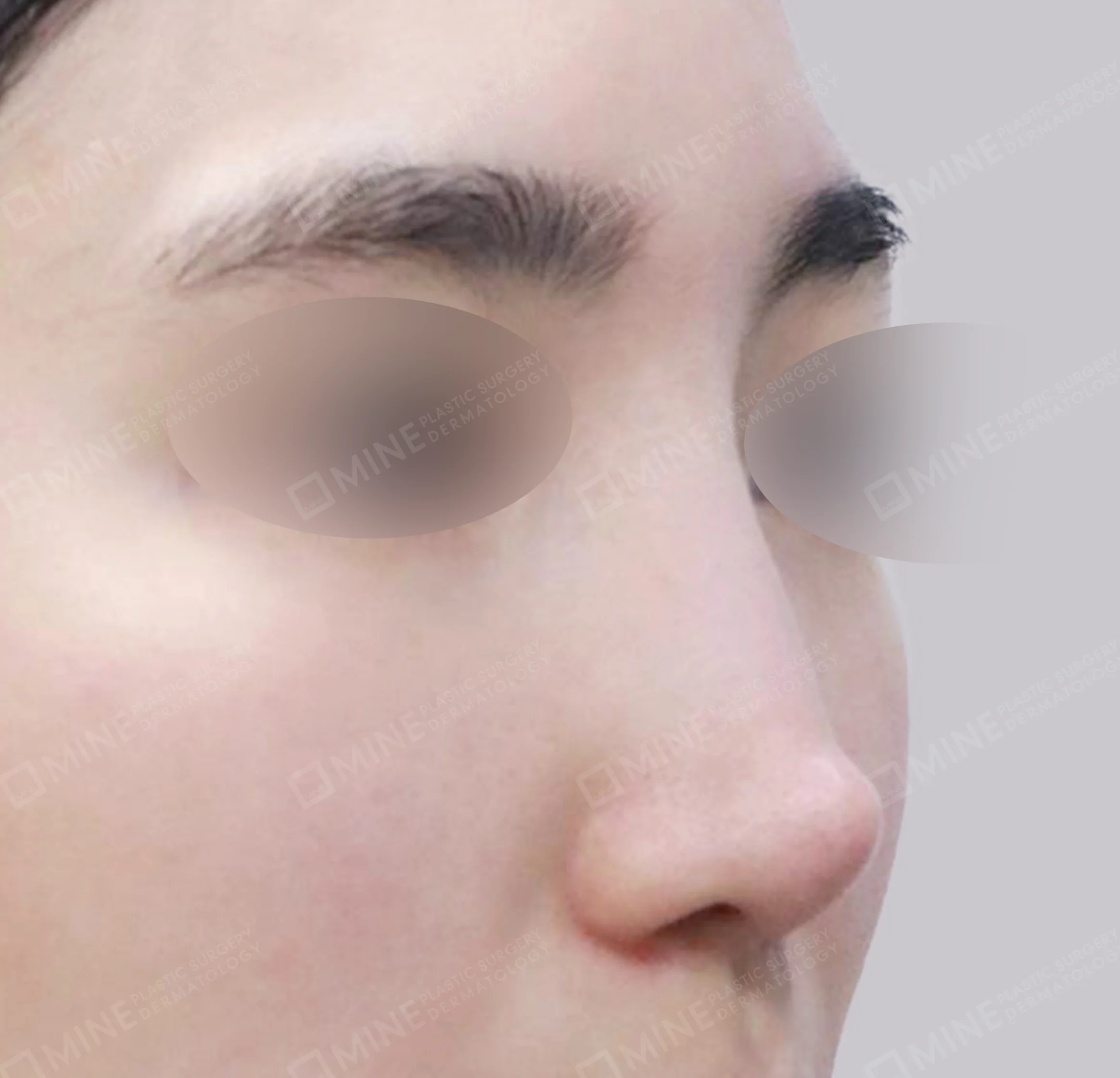 Revision Rhinoplasty-45도-전