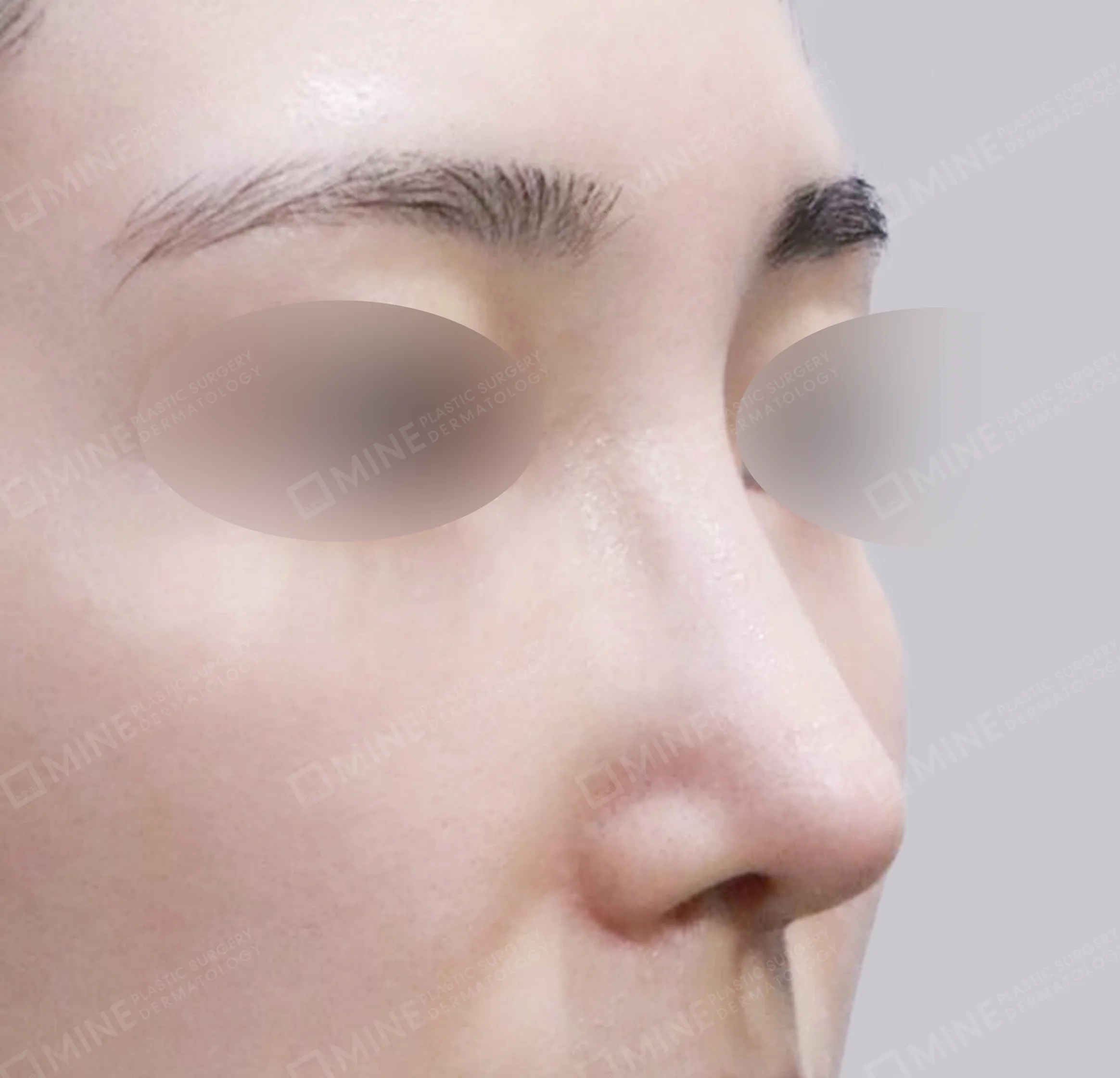 Revision Rhinoplasty-45도-후