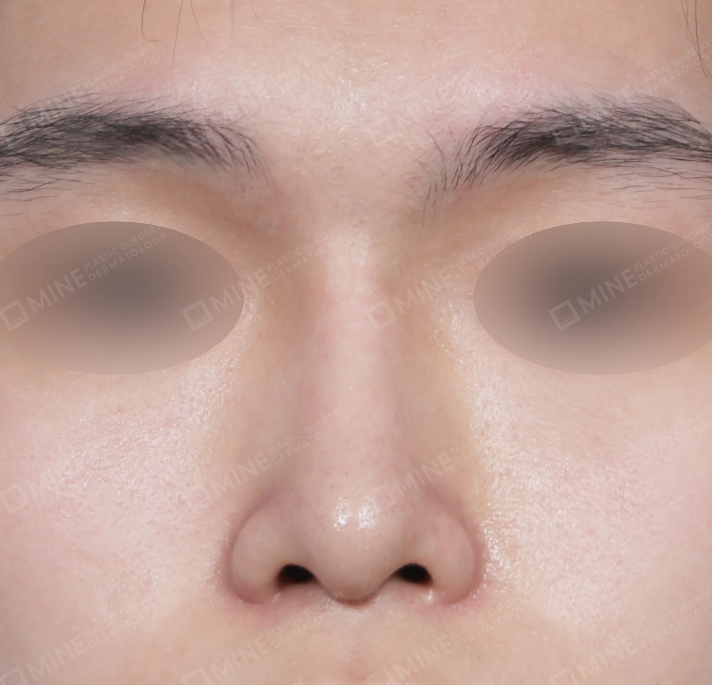 Bridge + Tip Plasty + Septal Extension + Tip Reduction-정면-후