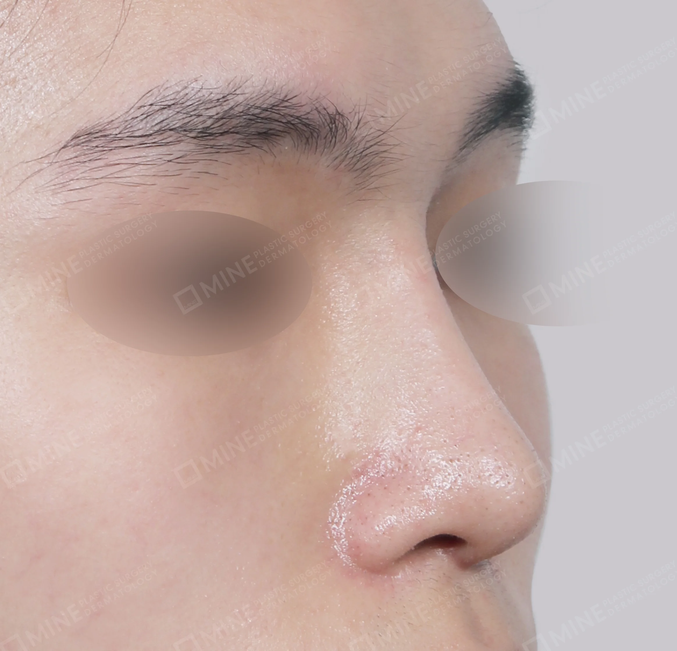 Bridge + Tip Plasty + Septal Extension + Tip Reduction-45도-후