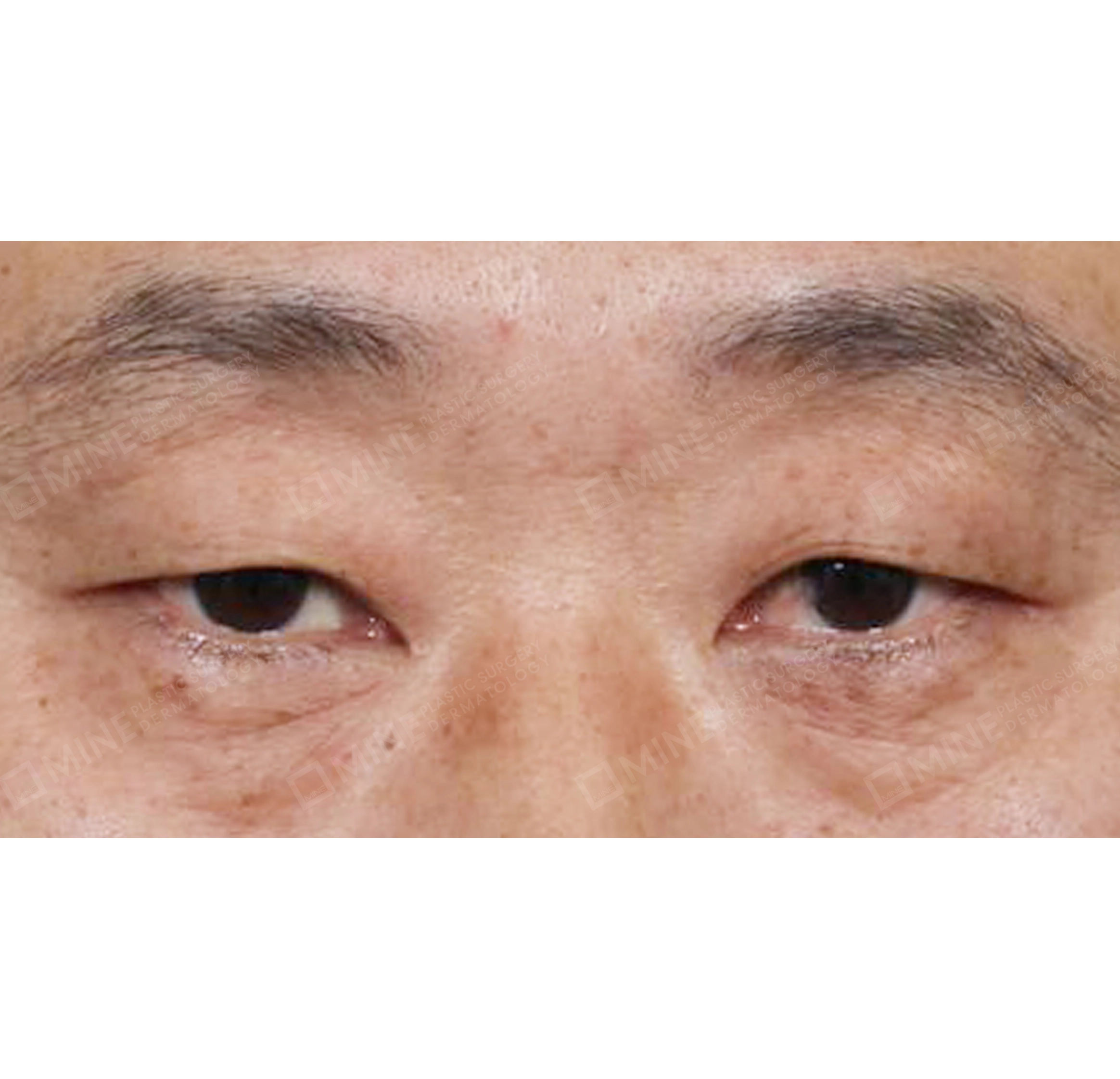 Upper Blepharoplasty-정면-전