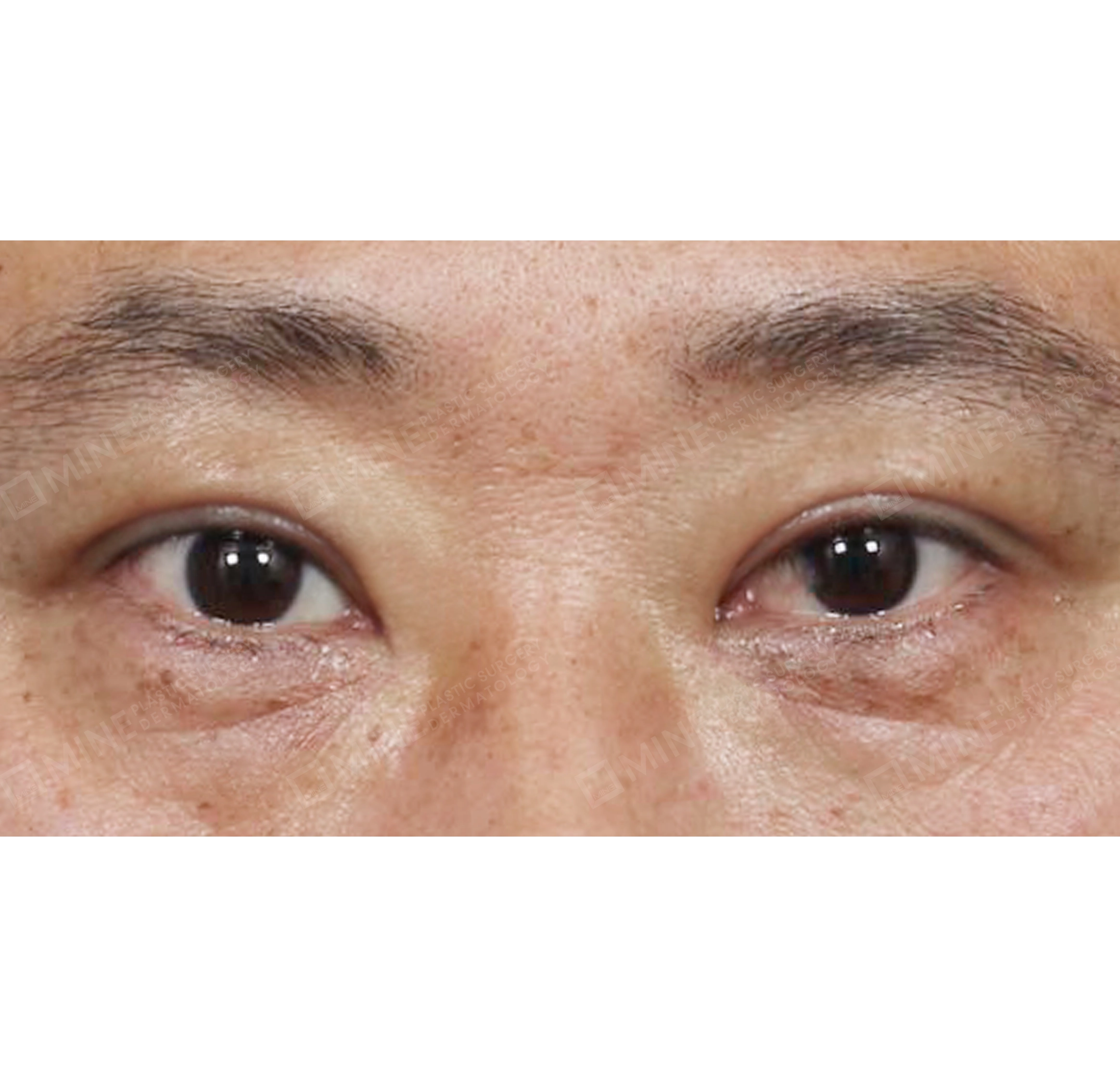 Upper Blepharoplasty-정면-후