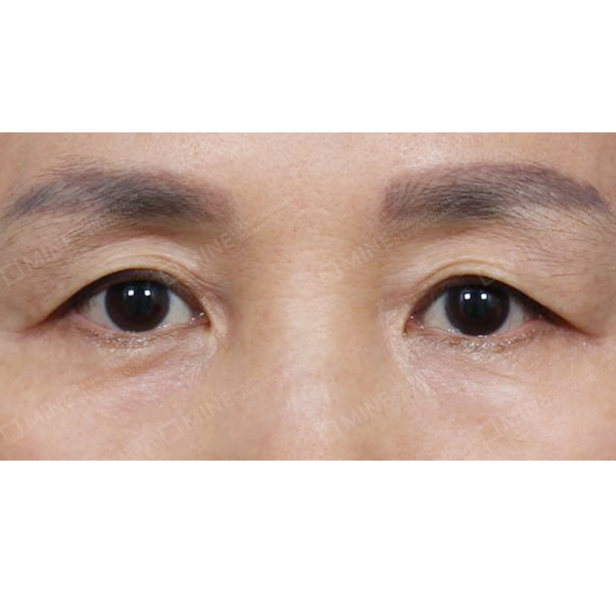 Upper & Lower Blepharoplasty + Subbrow Lift-정면-전